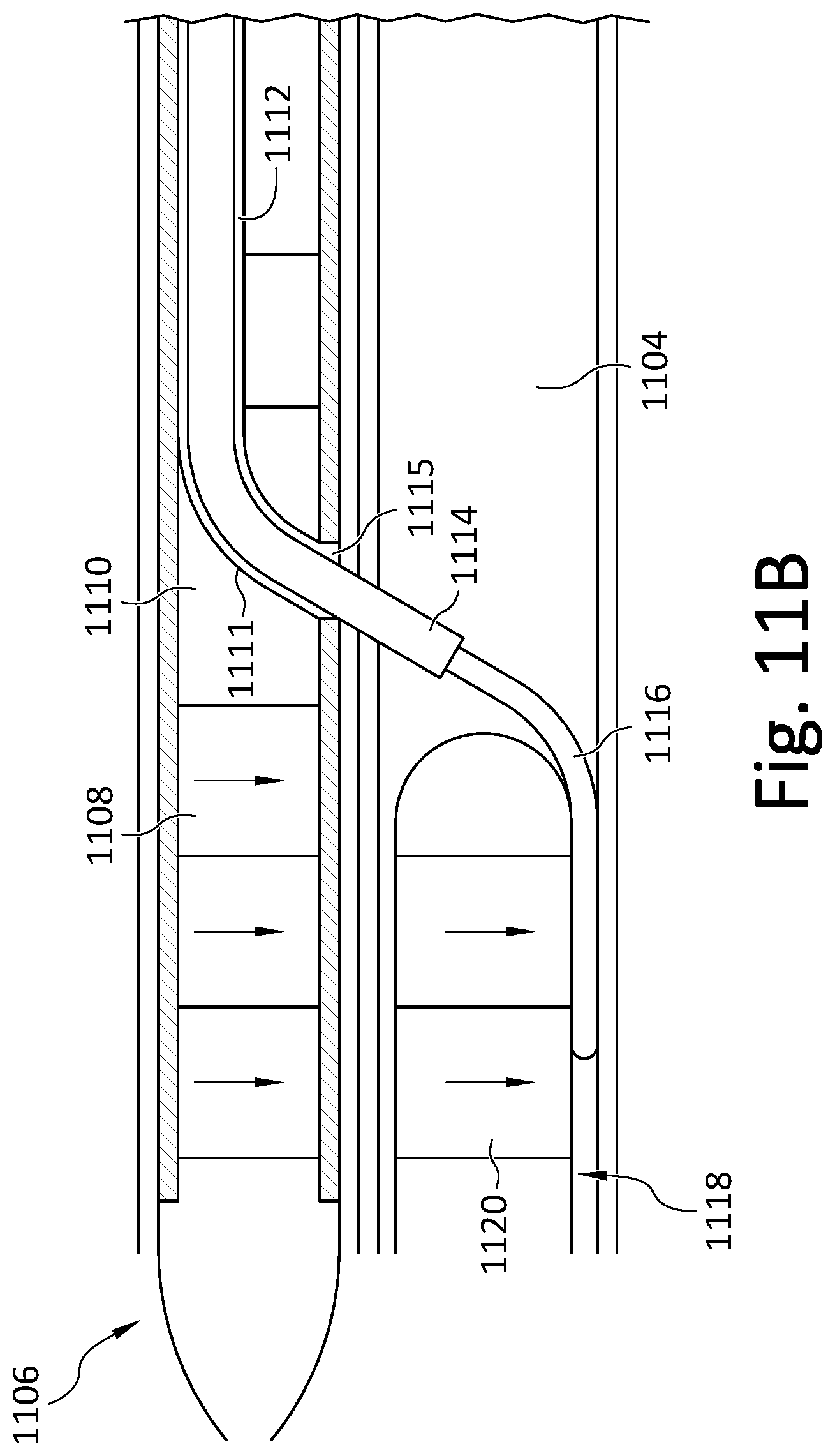 Patent US12508400 Figure 17 – Devices and methods for advancing a wire