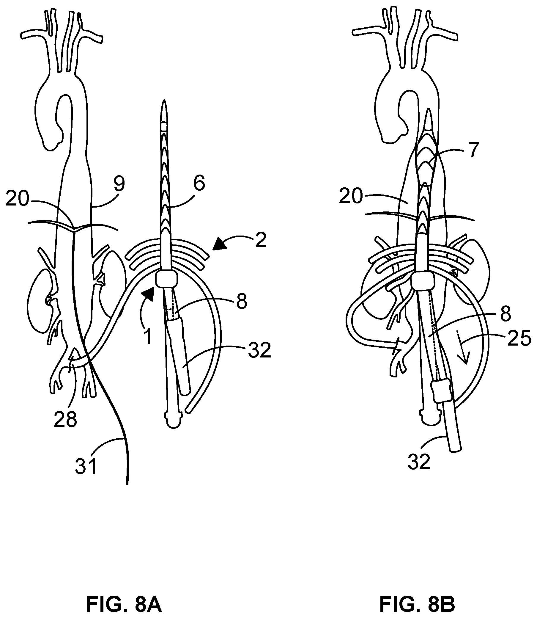 Patent US12508404 Figure 6 – Sheath splitting apparatus