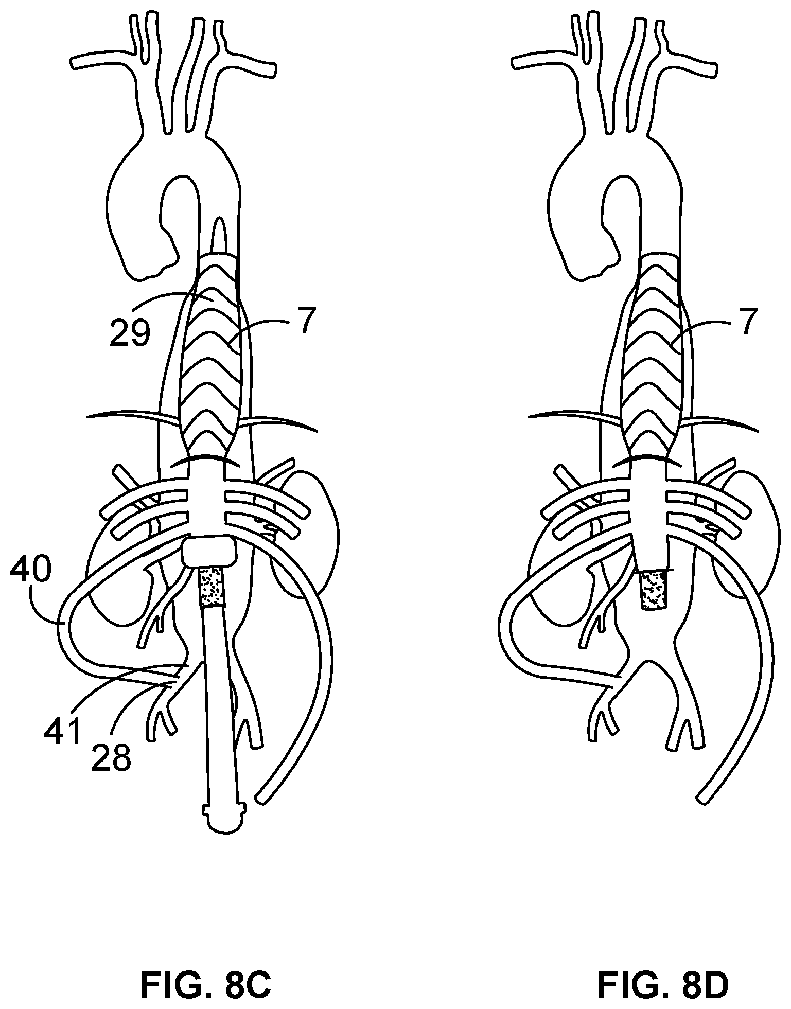 Patent US12508404 Figure 7 – Sheath splitting apparatus