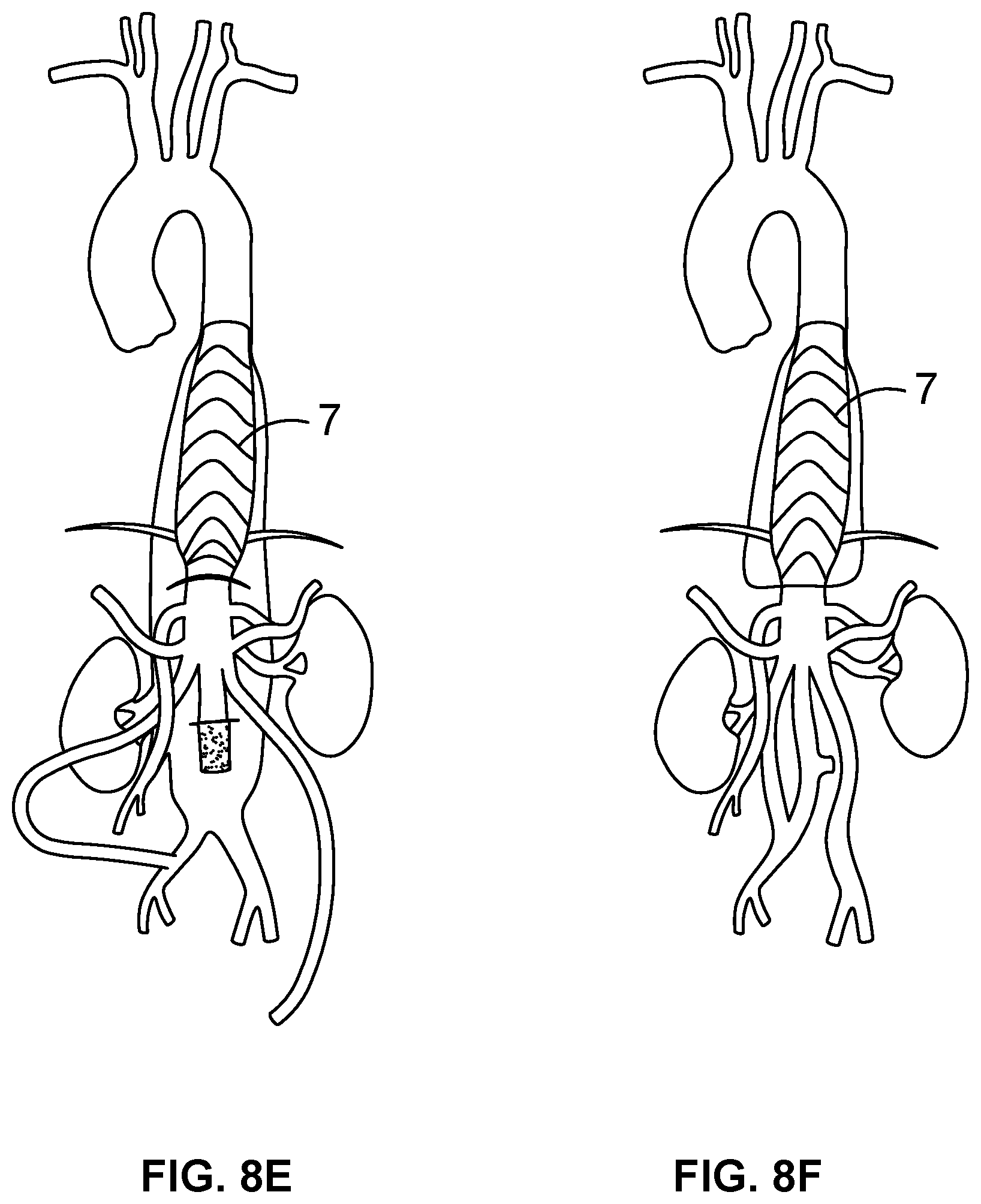 Patent US12508404 Figure 8 – Sheath splitting apparatus