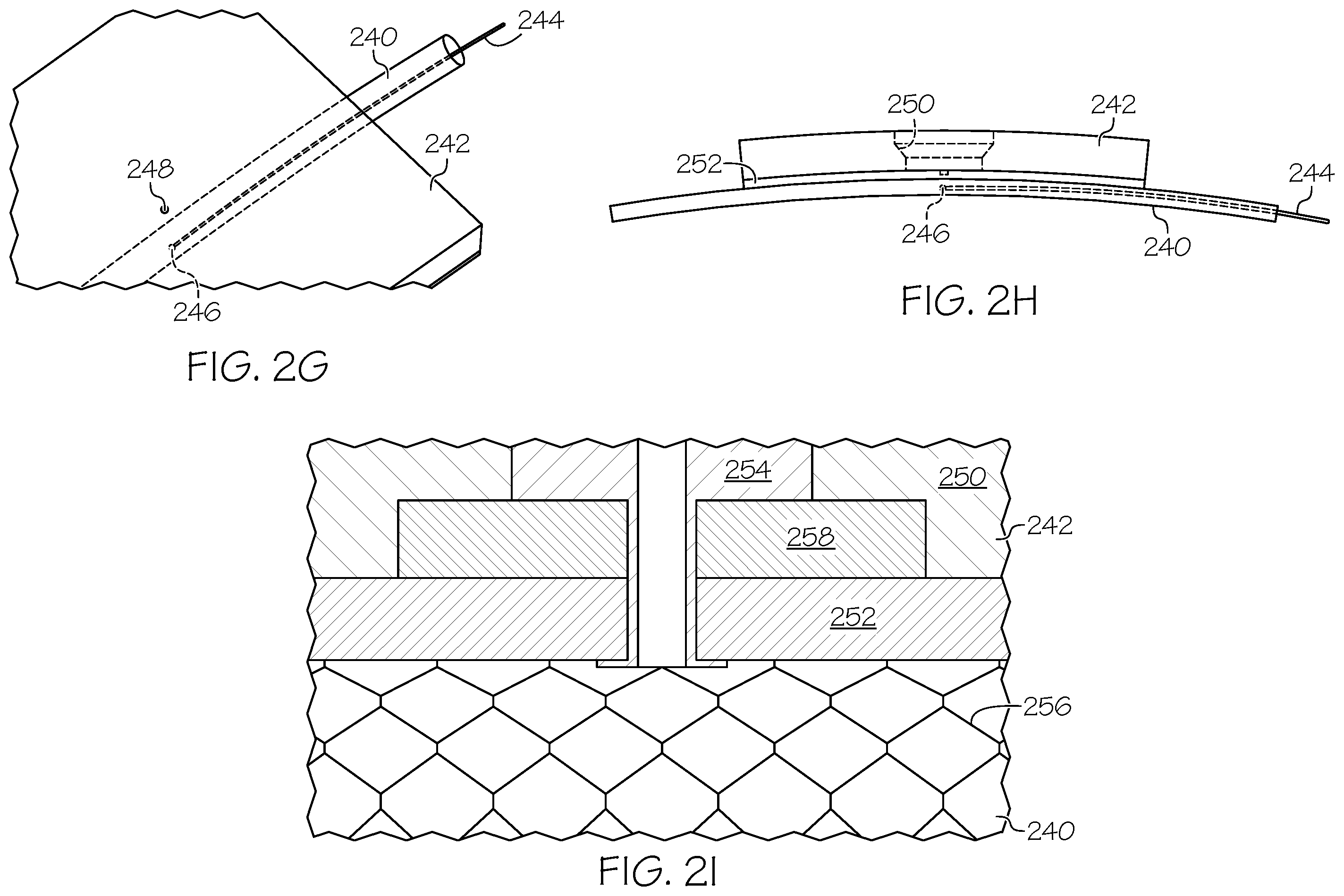 Patent US12508405 Figure 4 – Surgical method, device, system and kit for the treatment of hydrocephalus