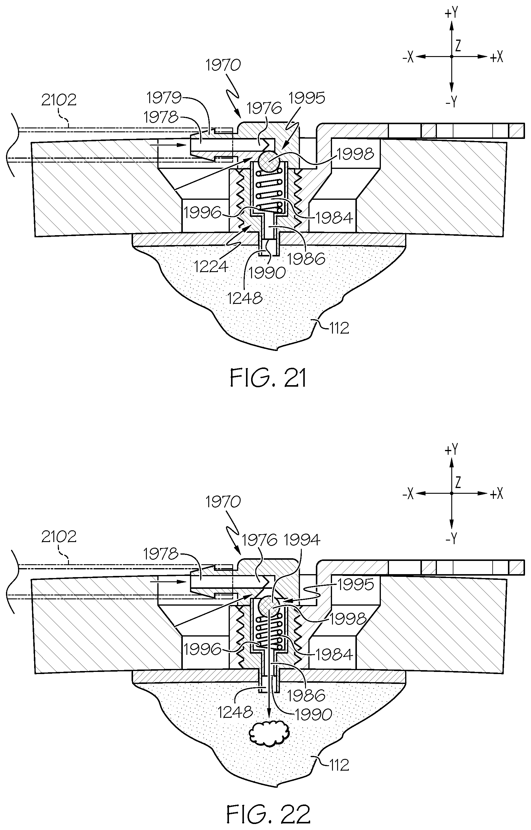 Patent US12508405 Figure 14 – Surgical method, device, system and kit for the treatment of hydrocephalus