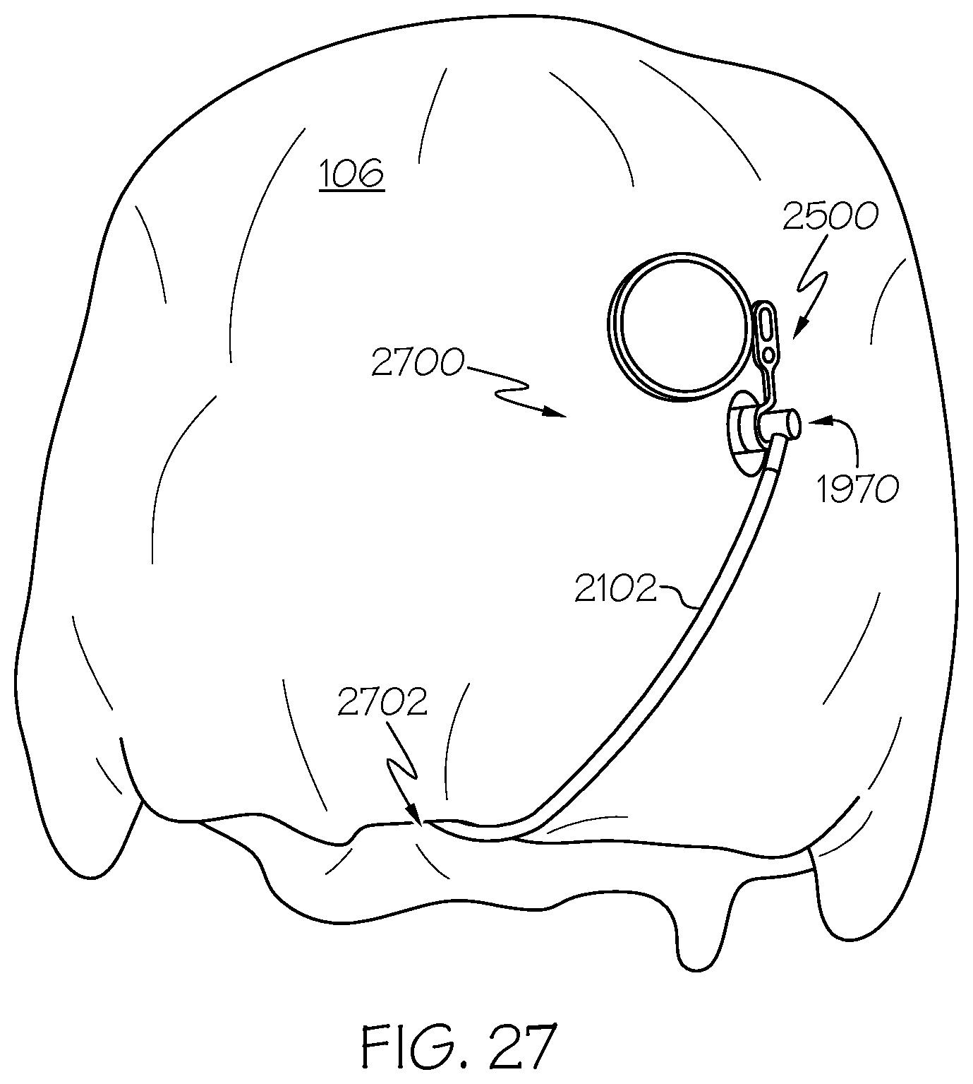 Patent US12508405 Figure 17 – Surgical method, device, system and kit for the treatment of hydrocephalus