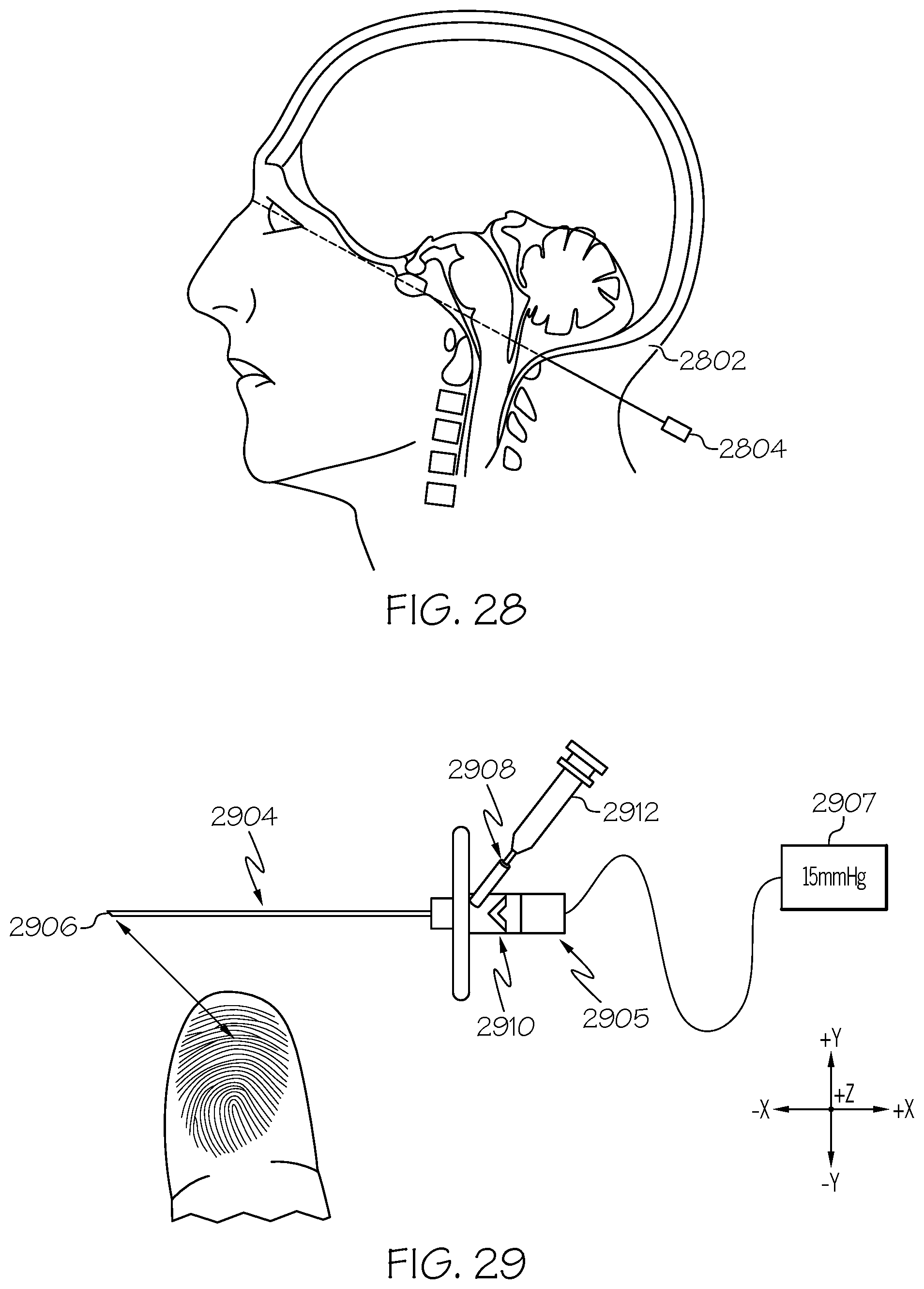 Patent US12508405 Figure 18 – Surgical method, device, system and kit for the treatment of hydrocephalus