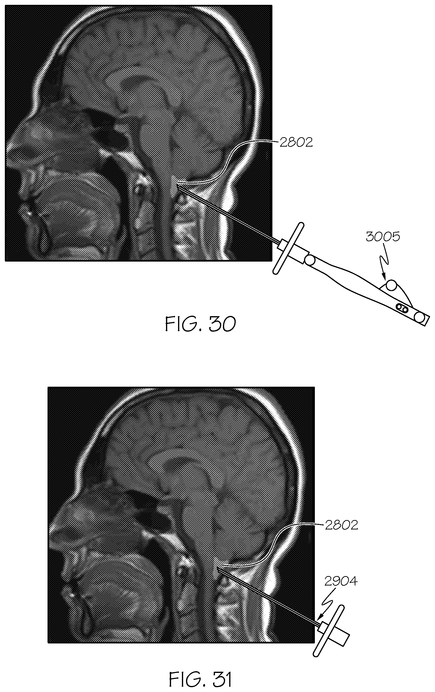 Patent US12508405 Figure 19 – Surgical method, device, system and kit for the treatment of hydrocephalus