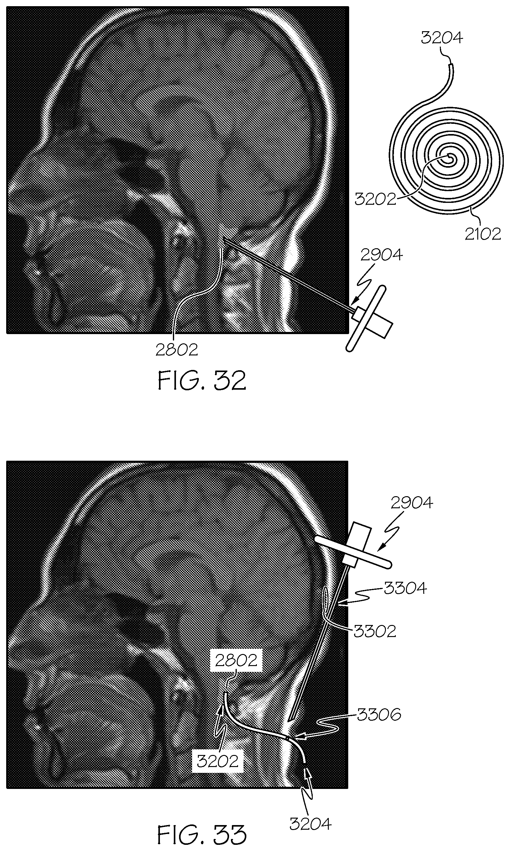 Patent US12508405 Figure 20 – Surgical method, device, system and kit for the treatment of hydrocephalus