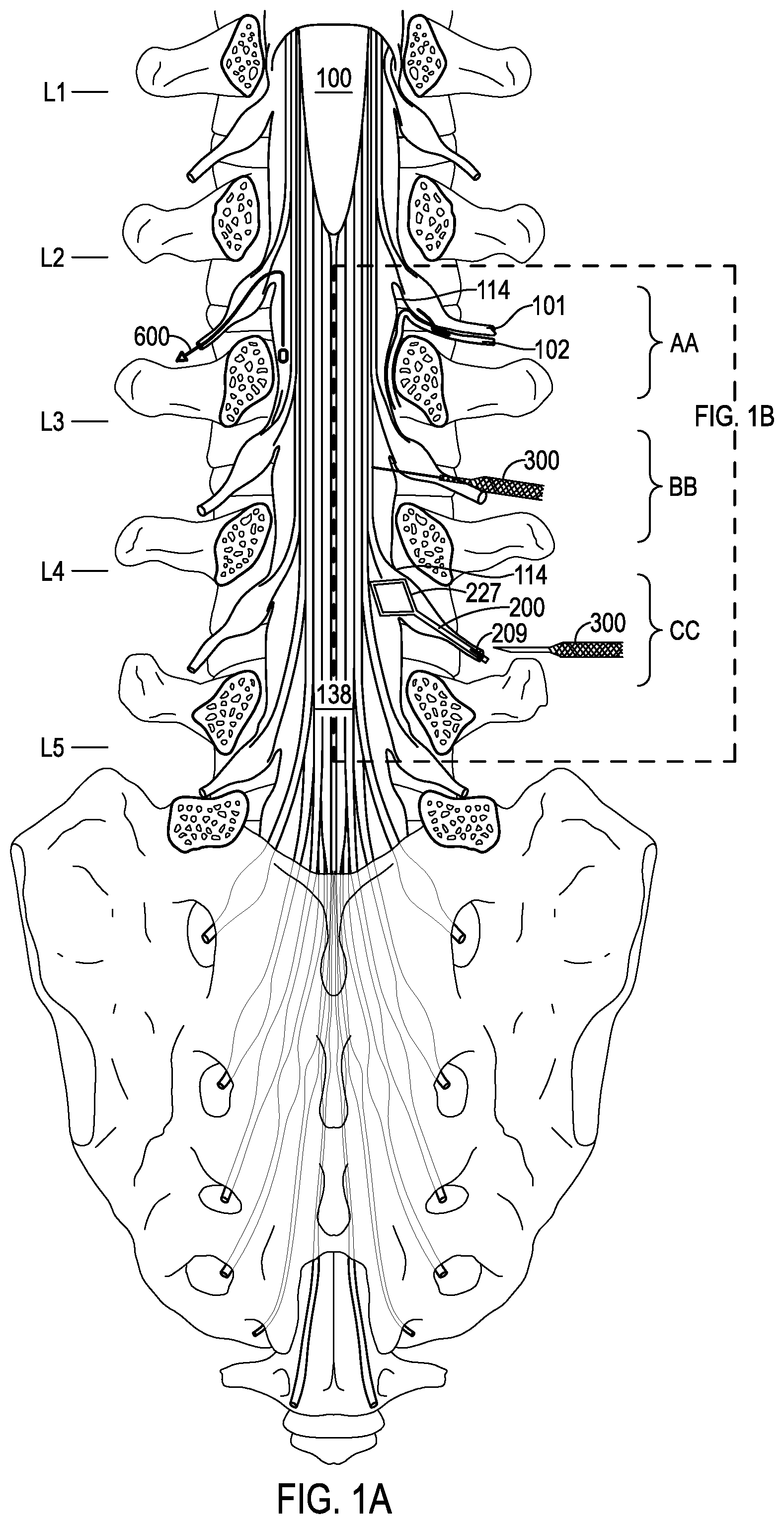 Patent US12508406 Figure 1 – Systems and methods for treating hydrocephalus
