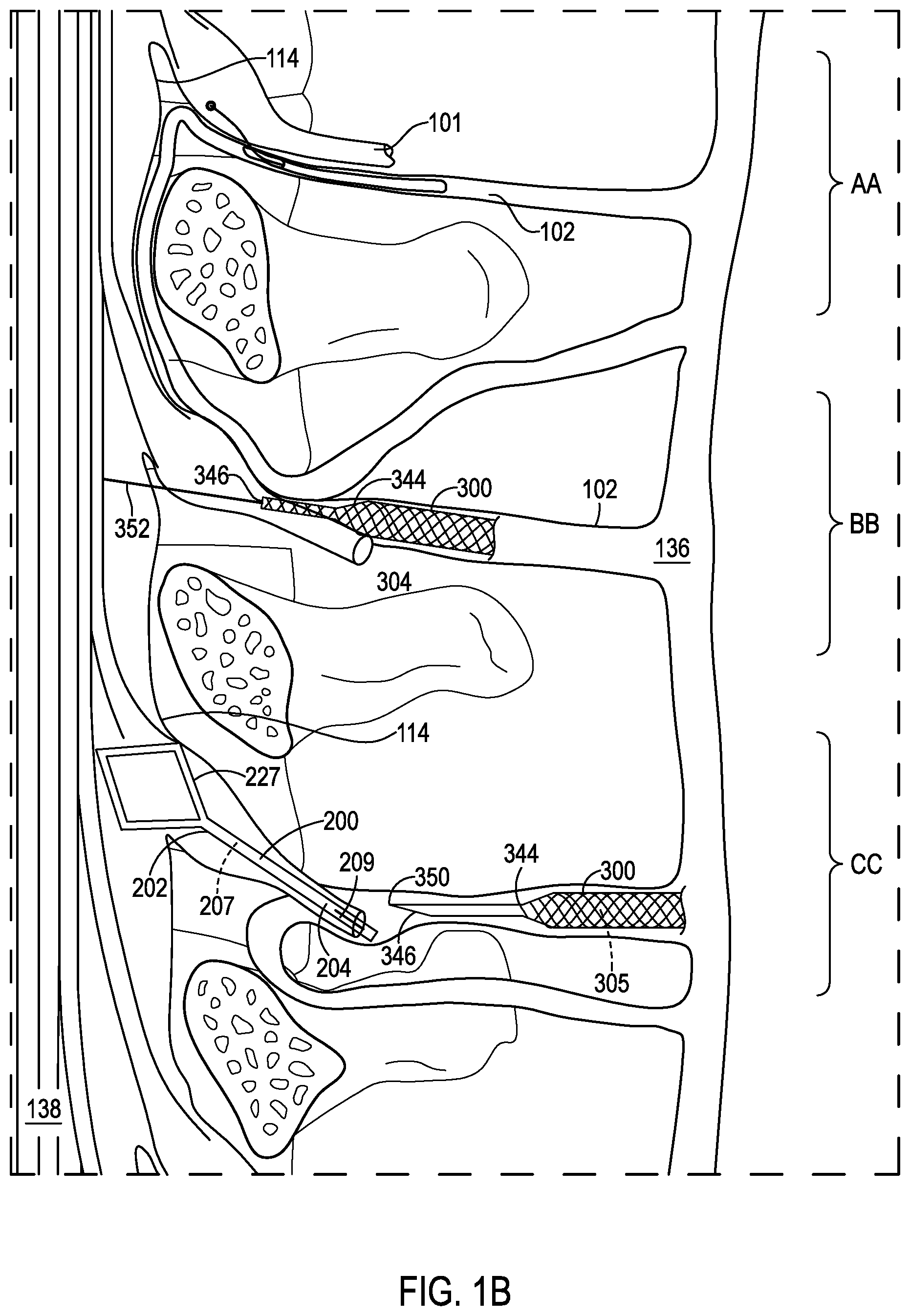 Patent US12508406 Figure 2 – Systems and methods for treating hydrocephalus