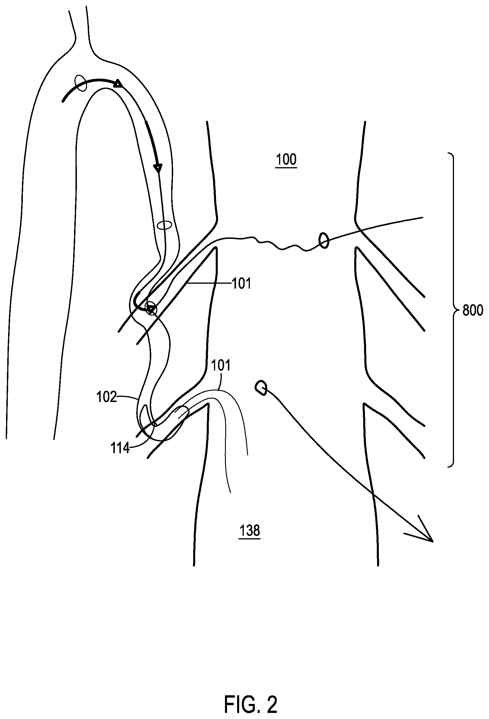 Patent US12508406 Figure 3 – Systems and methods for treating hydrocephalus