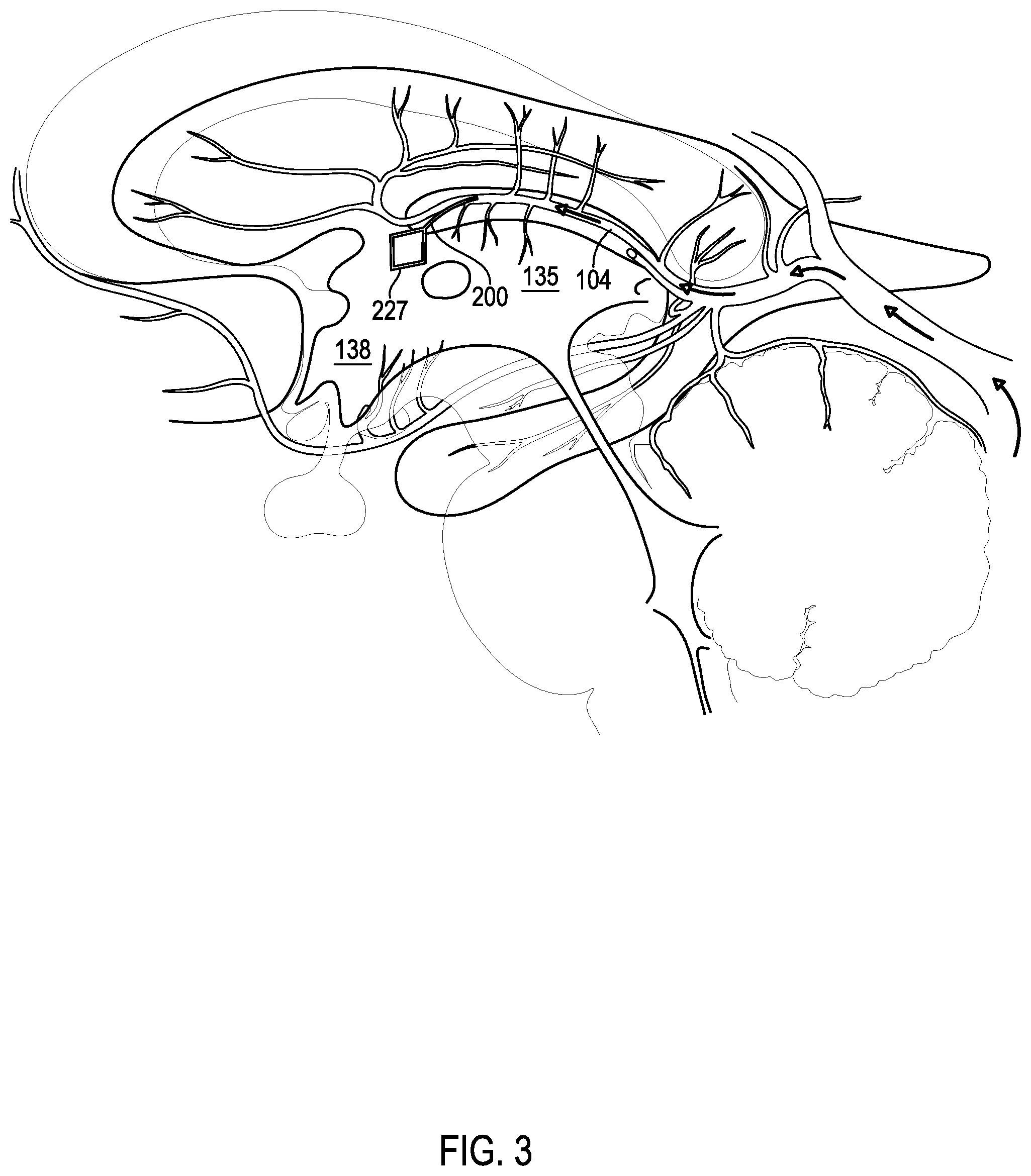 Patent US12508406 Figure 4 – Systems and methods for treating hydrocephalus
