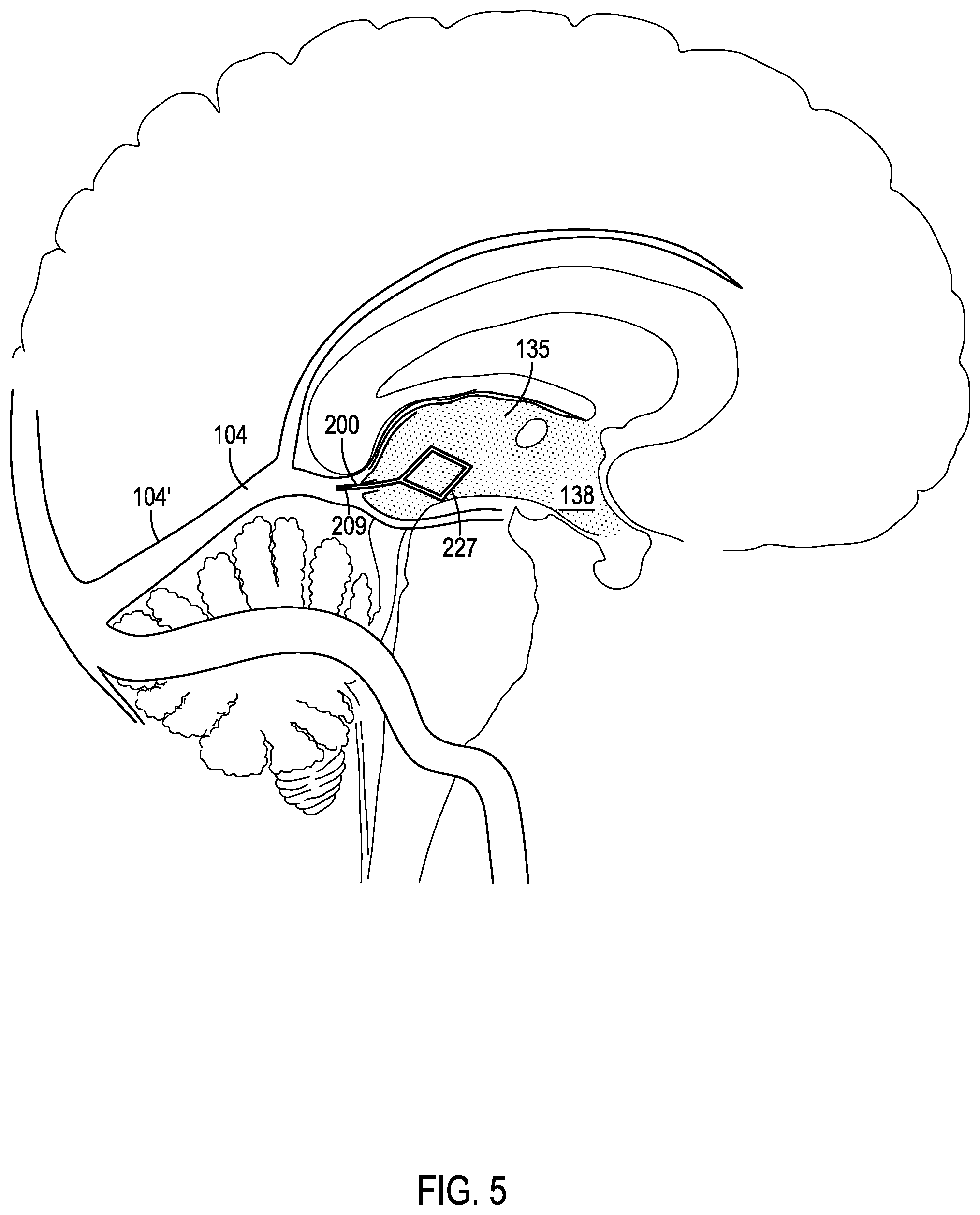 Patent US12508406 Figure 6 – Systems and methods for treating hydrocephalus