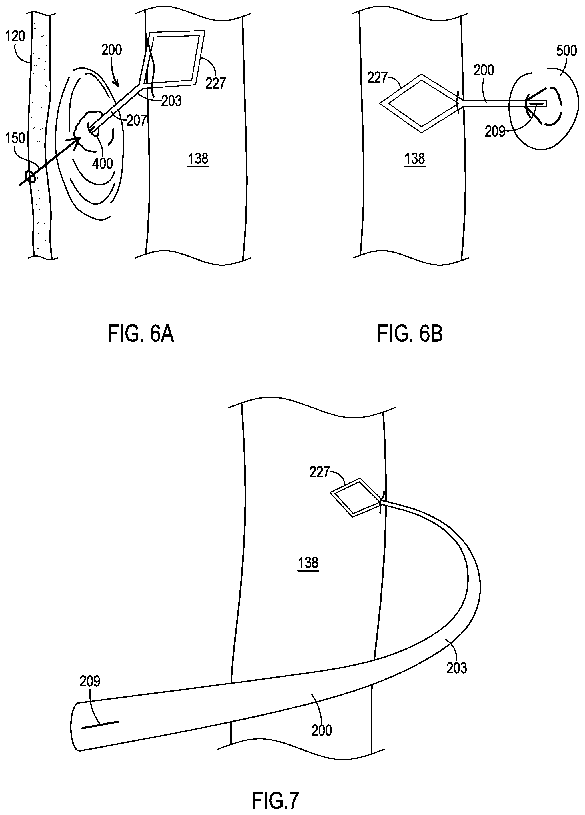 Patent US12508406 Figure 7 – Systems and methods for treating hydrocephalus