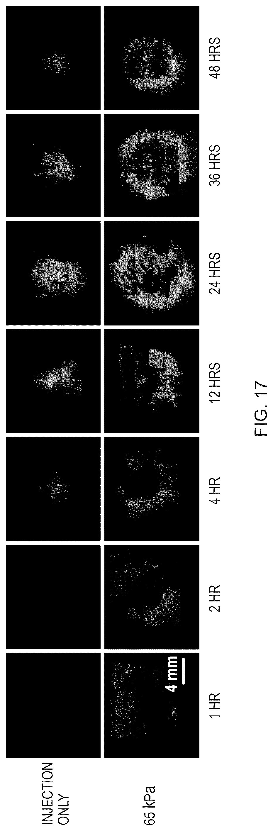 Patent US12508409 Figure 17 – System and method to use suction to enhance permeabilization and transfection of cells
