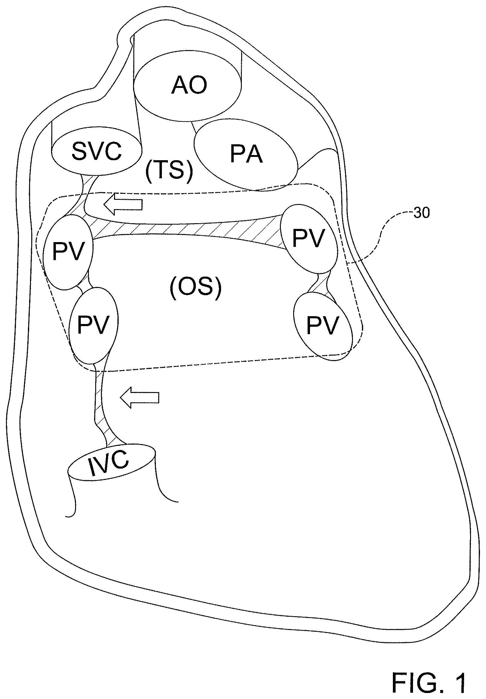 Patent US12508411 Figure 1 – Catheters, catheter systems, and methods for ablating a tissue region
