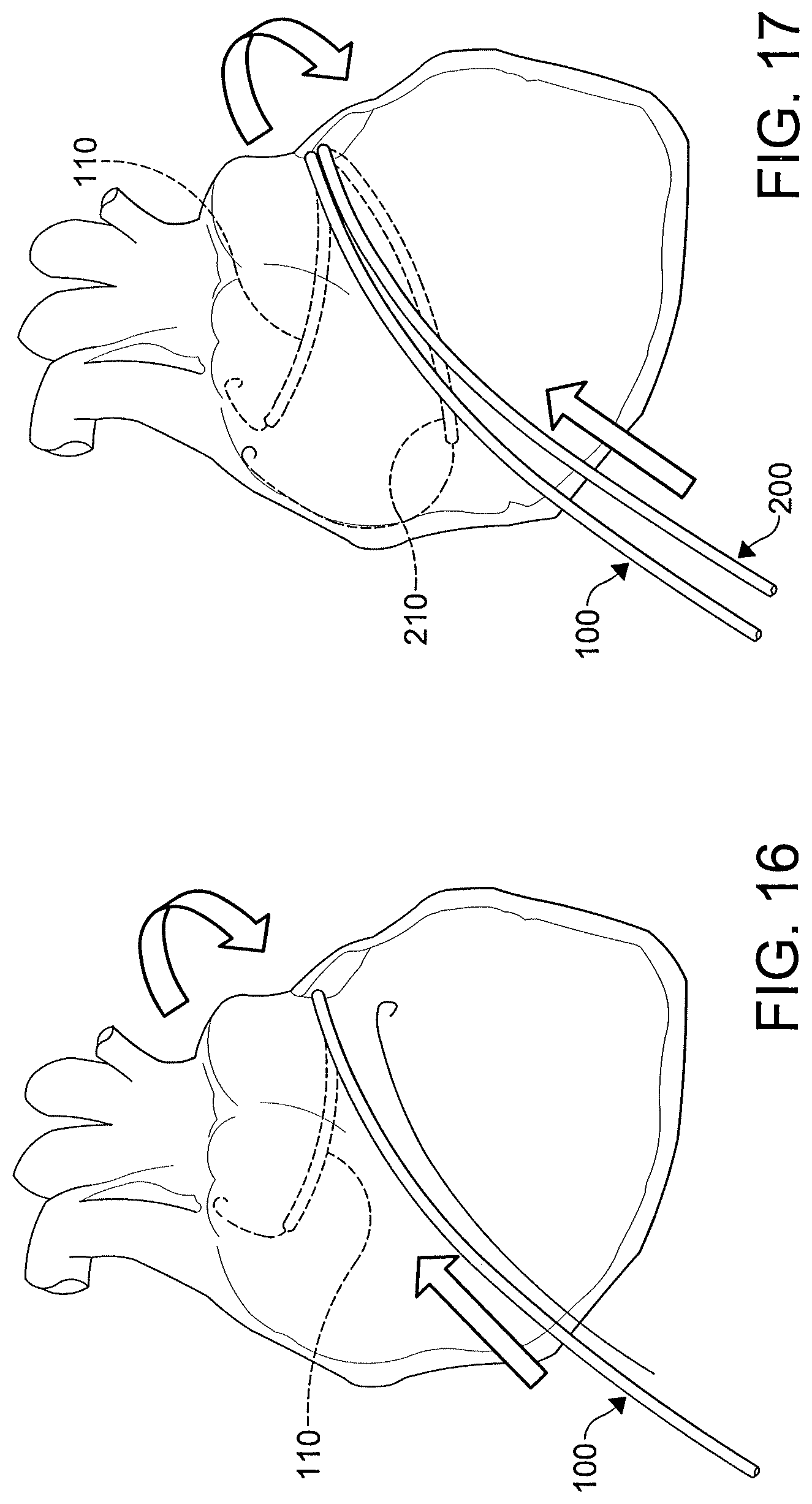 Patent US12508411 Figure 14 – Catheters, catheter systems, and methods for ablating a tissue region