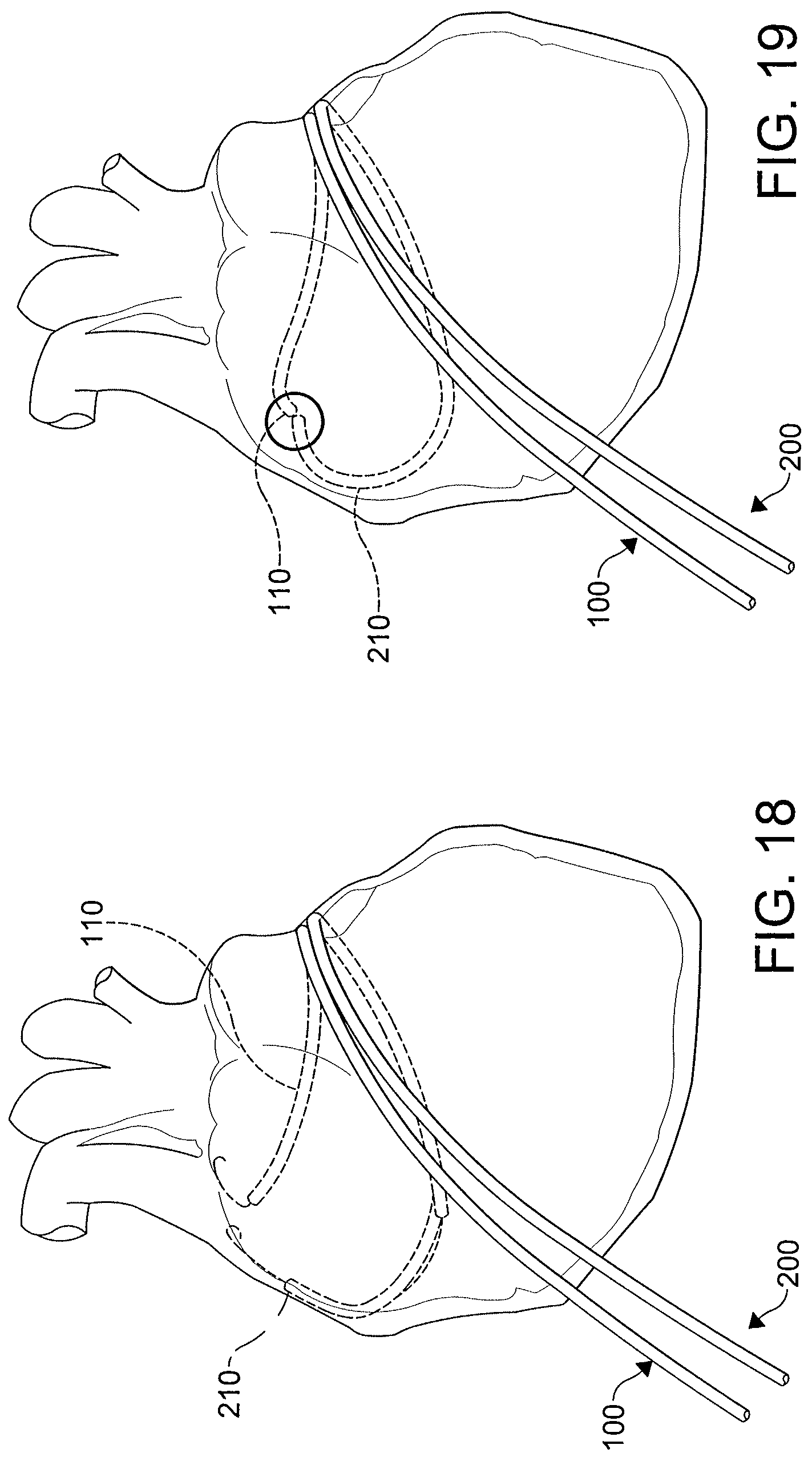Patent US12508411 Figure 15 – Catheters, catheter systems, and methods for ablating a tissue region