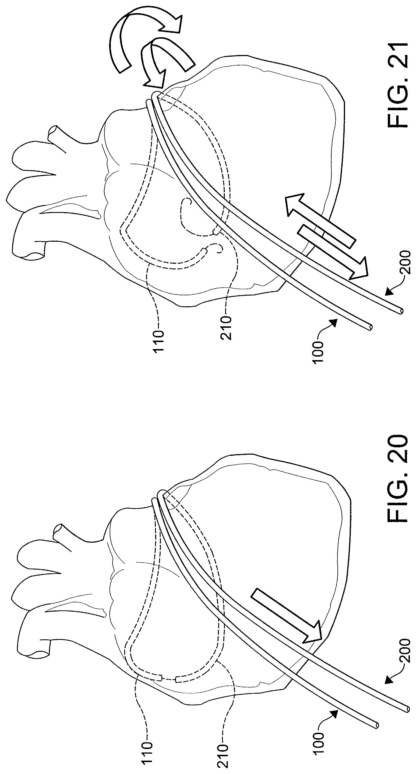 Patent US12508411 Figure 16 – Catheters, catheter systems, and methods for ablating a tissue region
