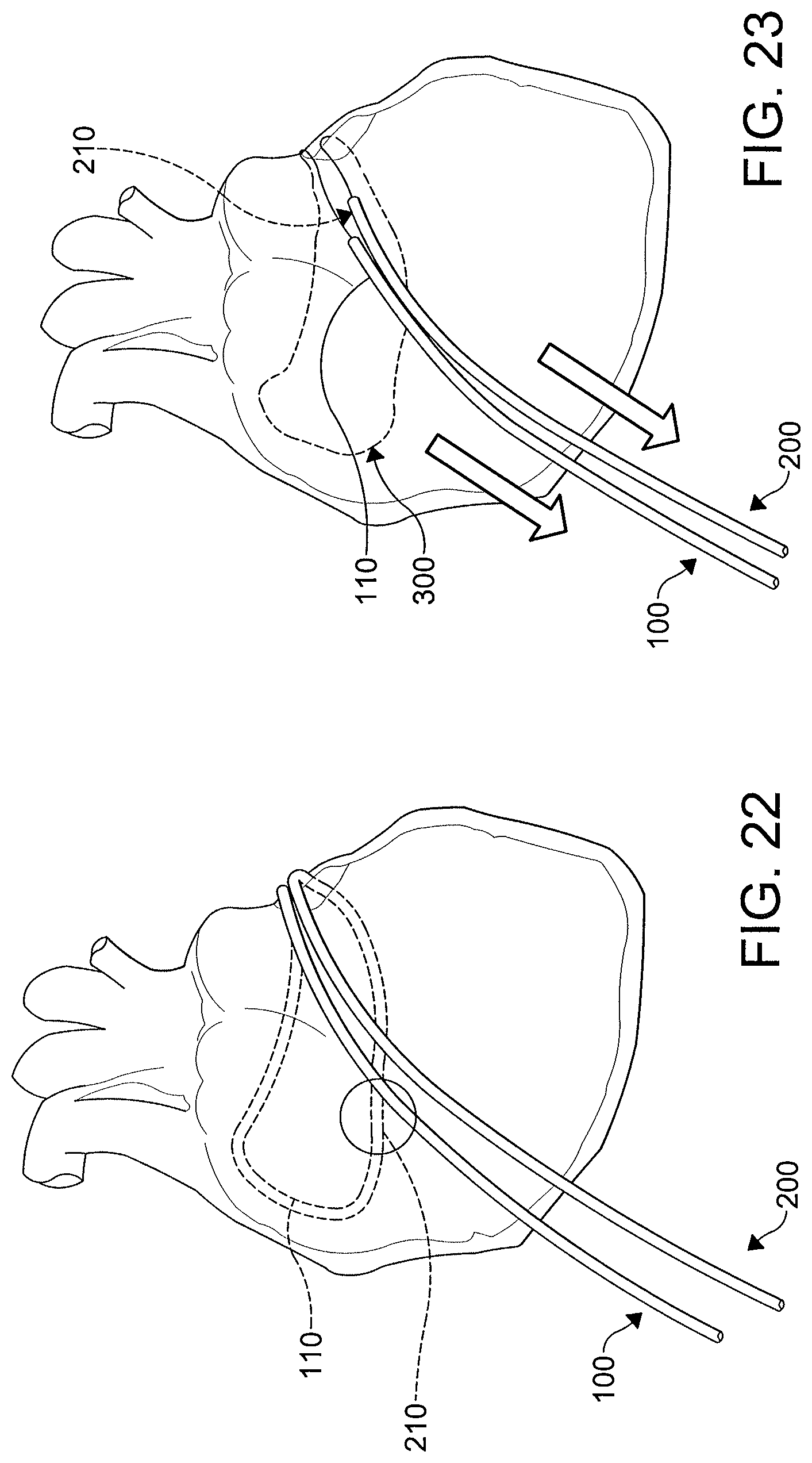 Patent US12508411 Figure 17 – Catheters, catheter systems, and methods for ablating a tissue region