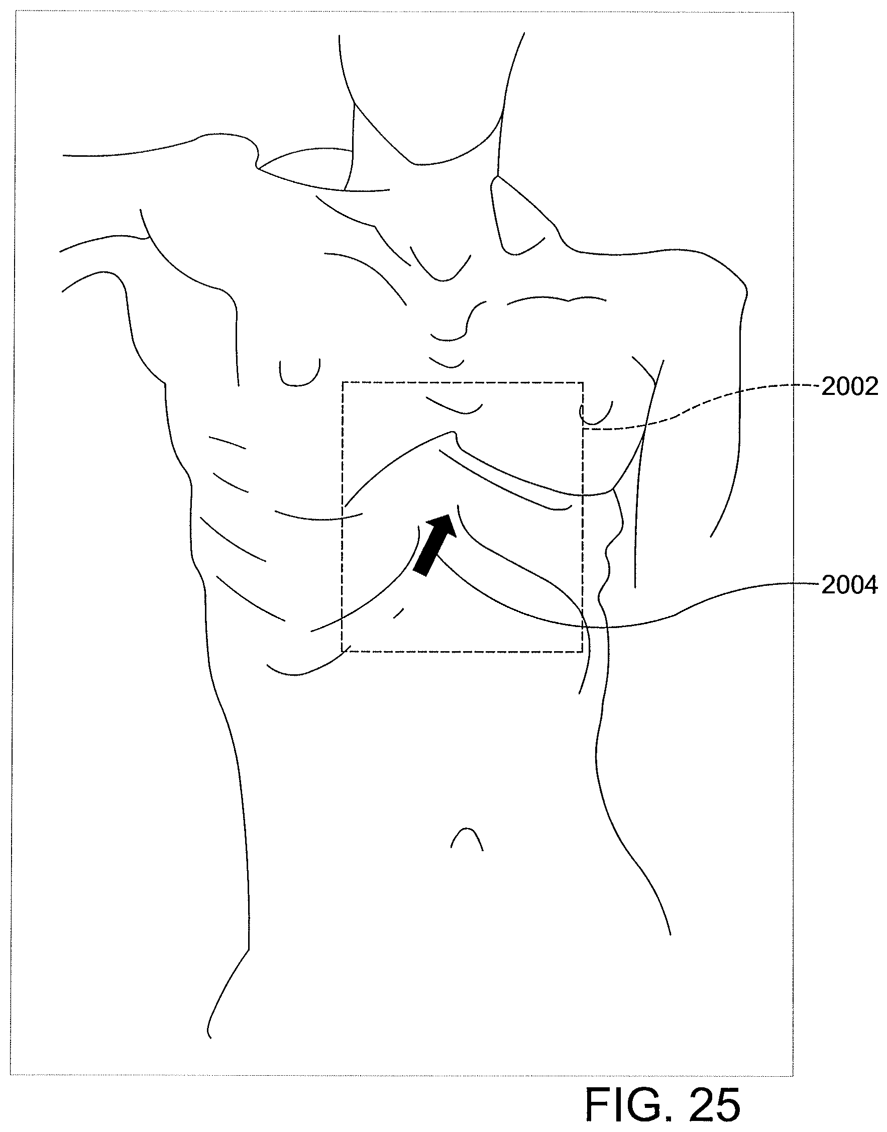 Patent US12508411 Figure 19 – Catheters, catheter systems, and methods for ablating a tissue region