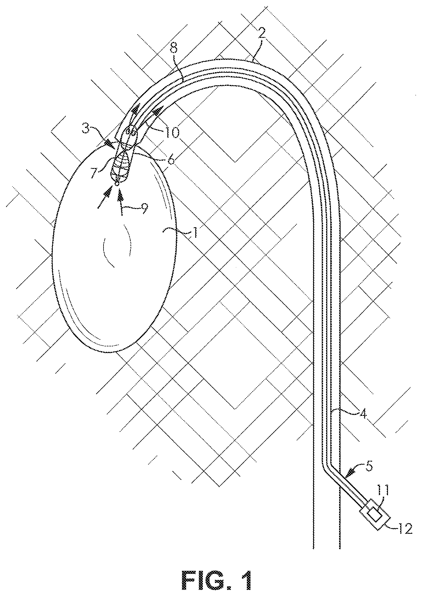 Patent US12508417 Figure 1 – Fluid pump changeable in diameter, in particular for medical application