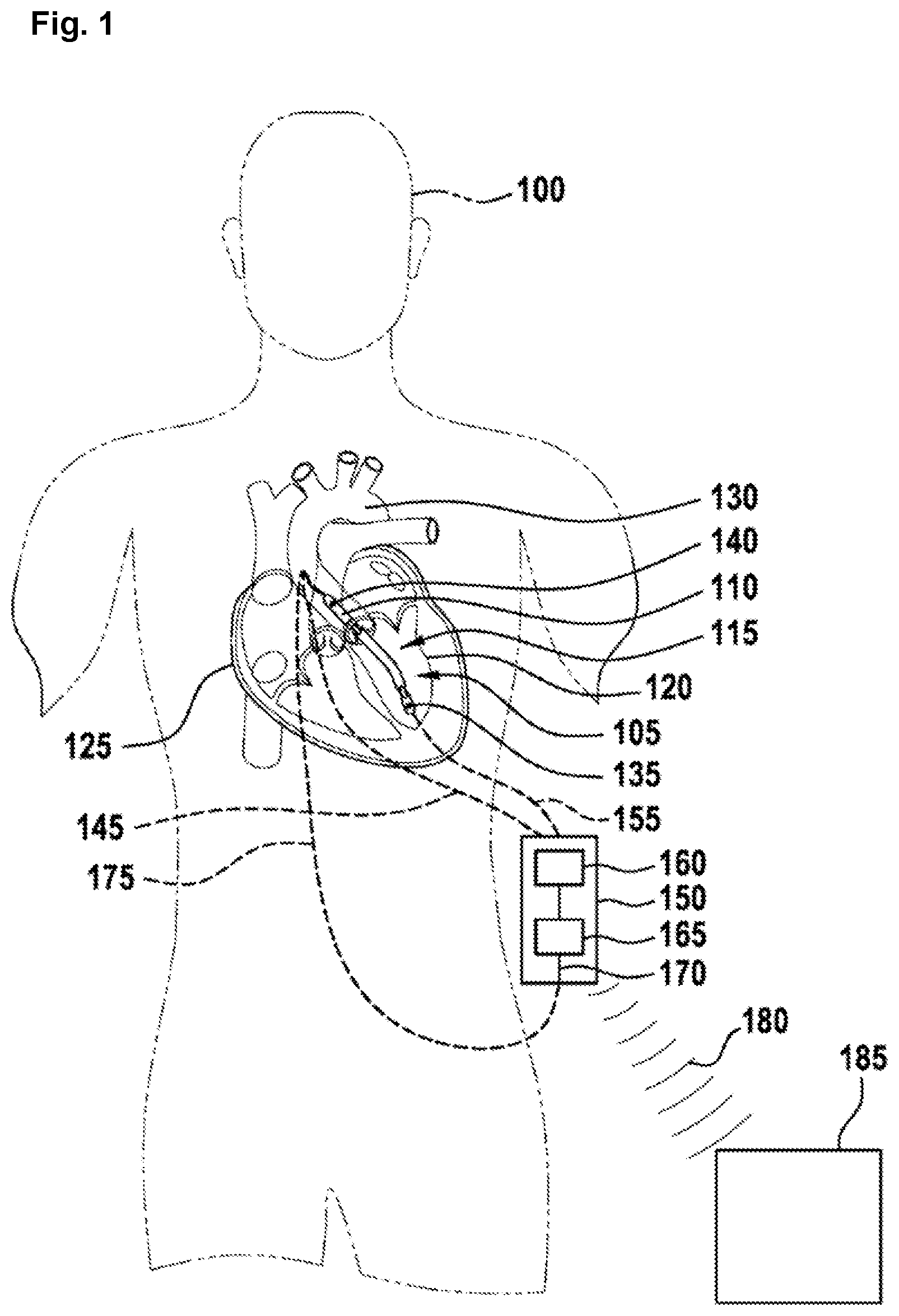 Patent US12508418 Figure 1 – Device and method for monitoring the state of health of a patient