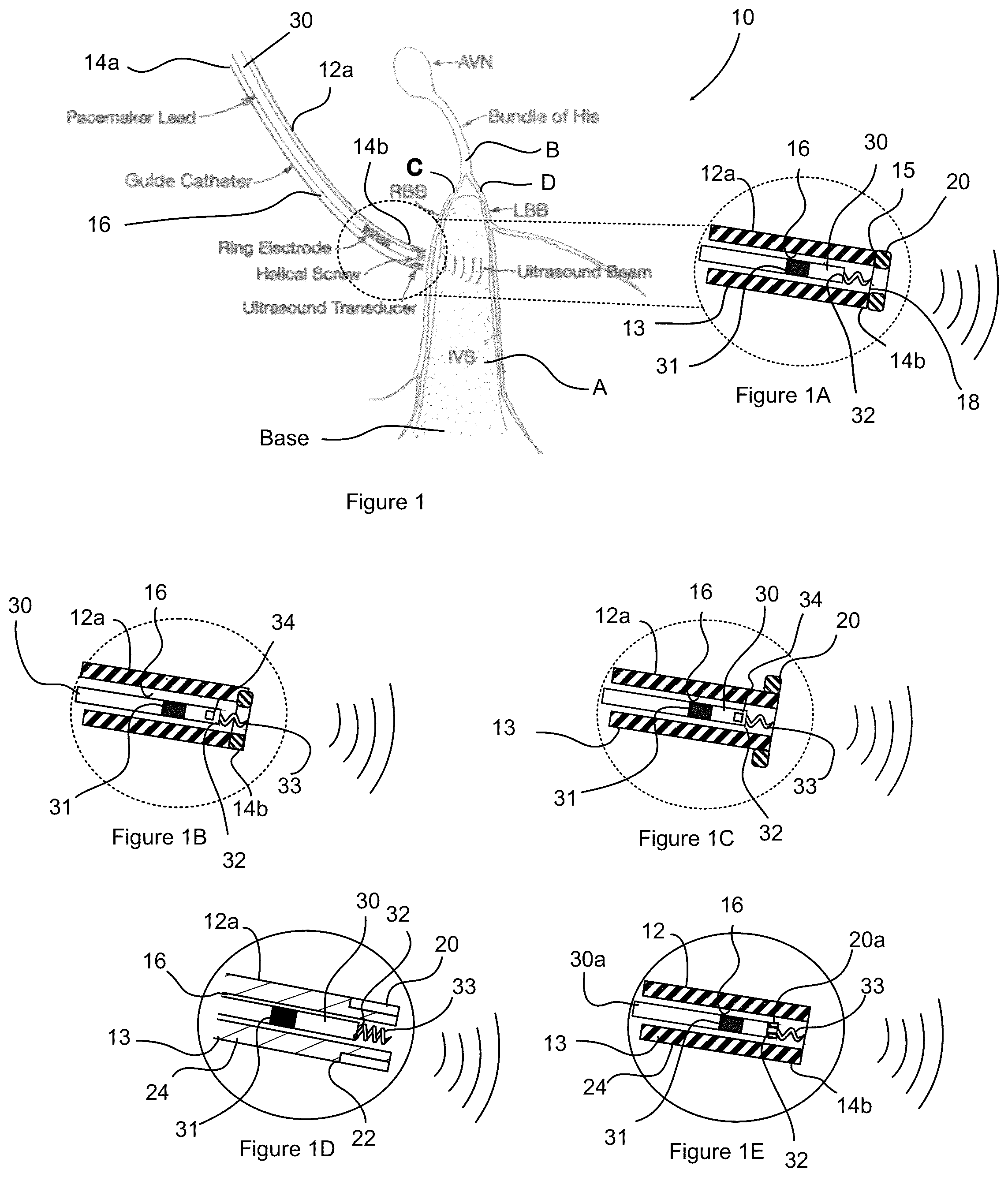 Patent US12508422 Figure 1 – Ultrasound guidance assembly and system