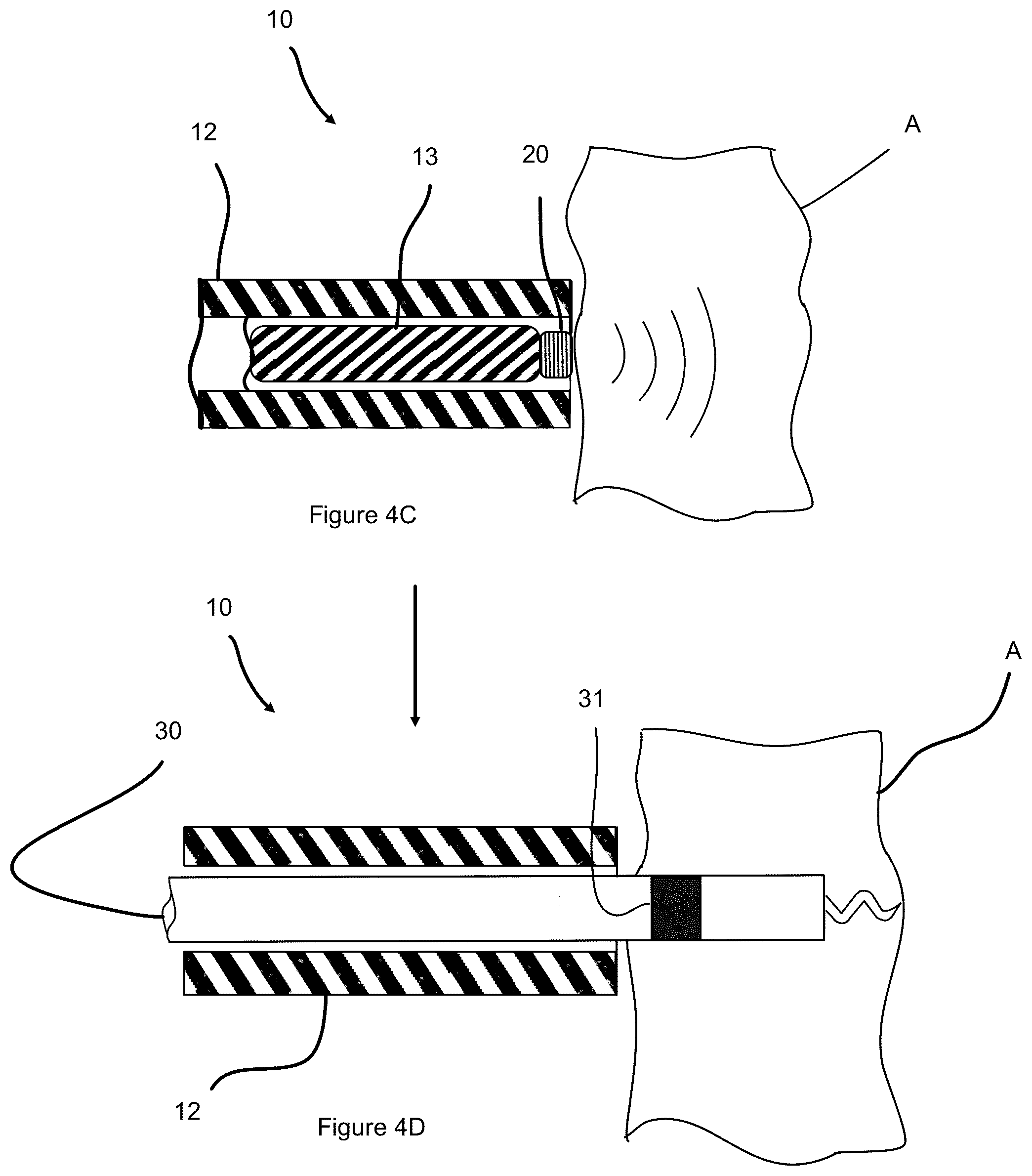 Patent US12508422 Figure 5 – Ultrasound guidance assembly and system