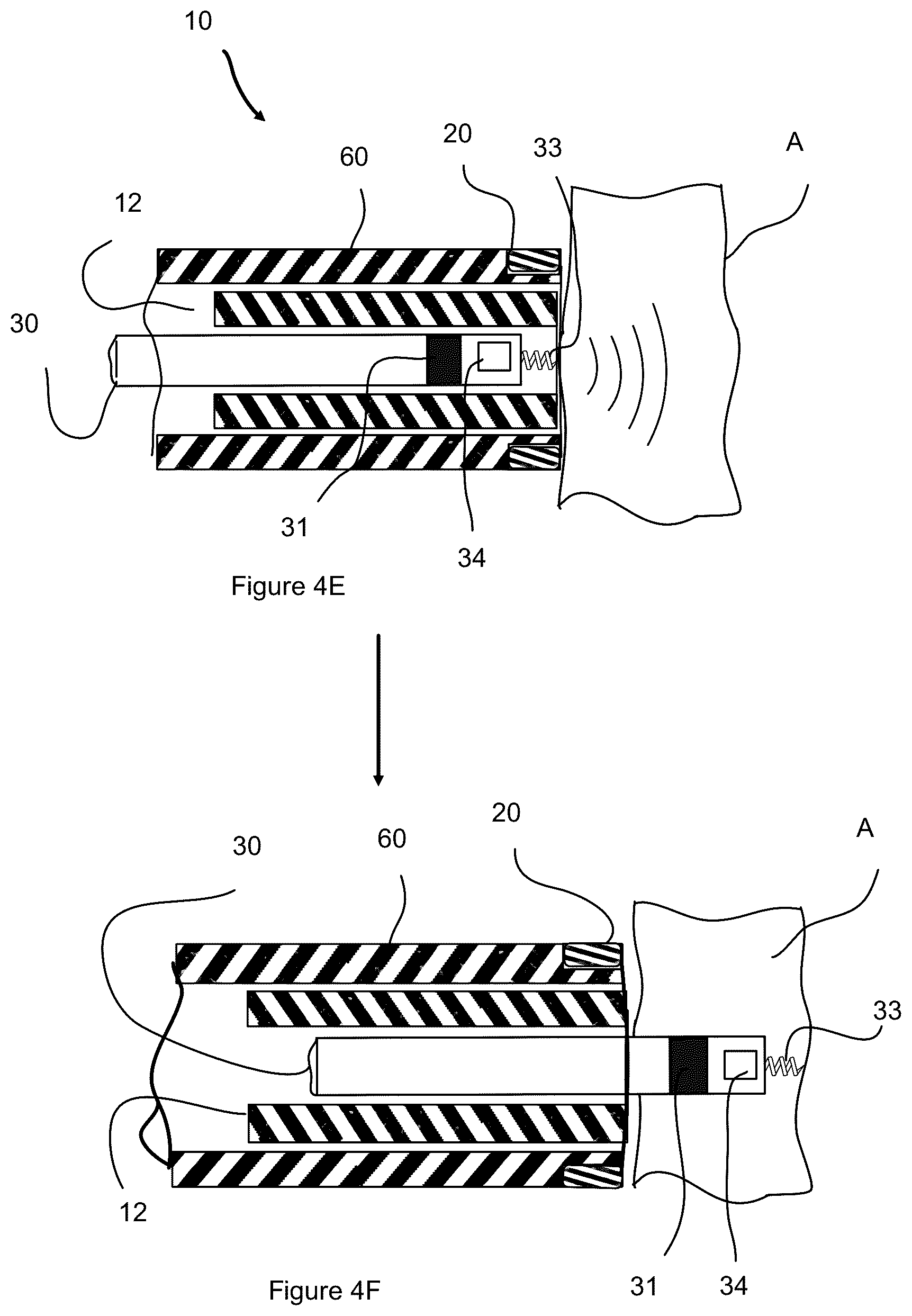 Patent US12508422 Figure 6 – Ultrasound guidance assembly and system