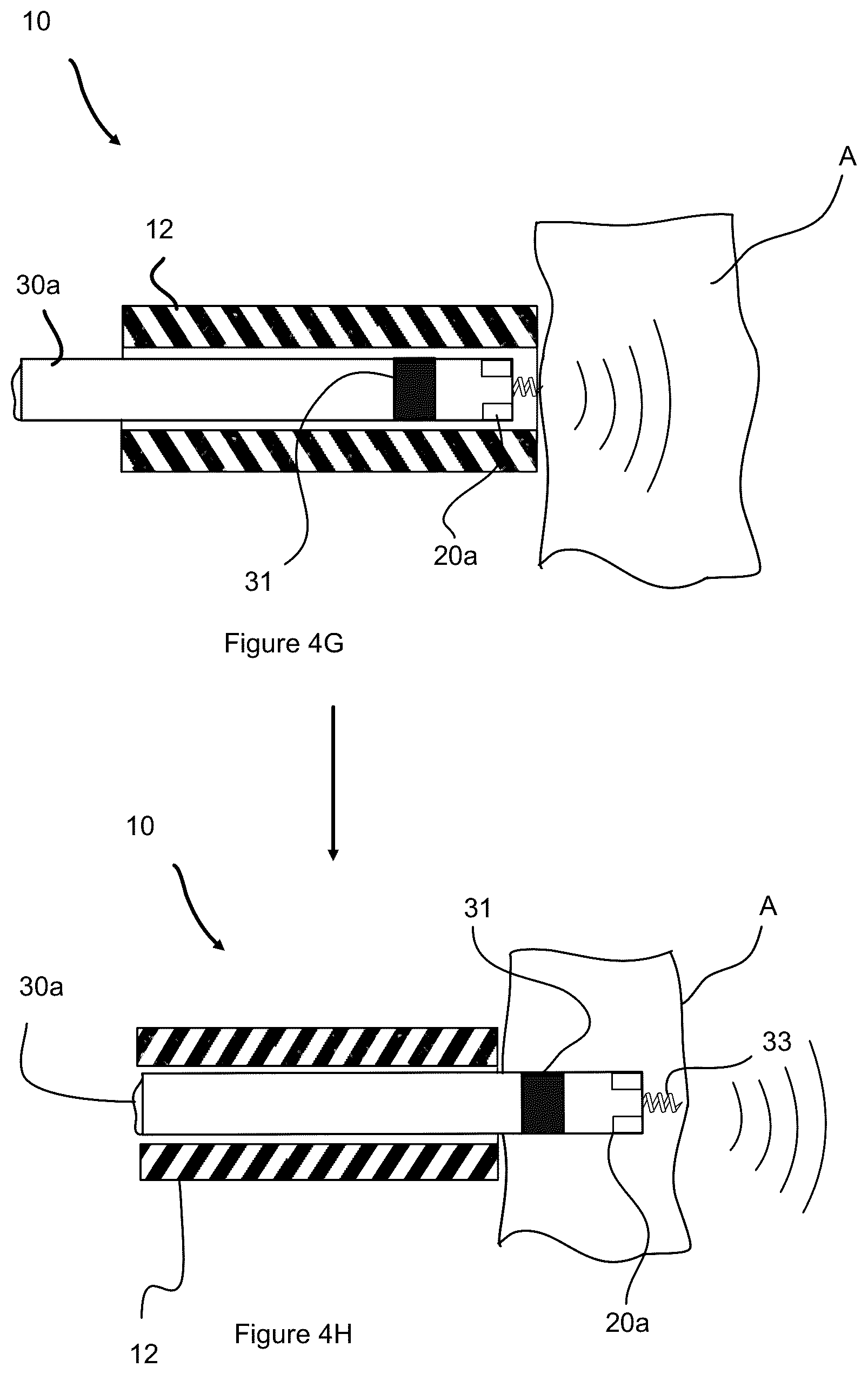 Patent US12508422 Figure 7 – Ultrasound guidance assembly and system