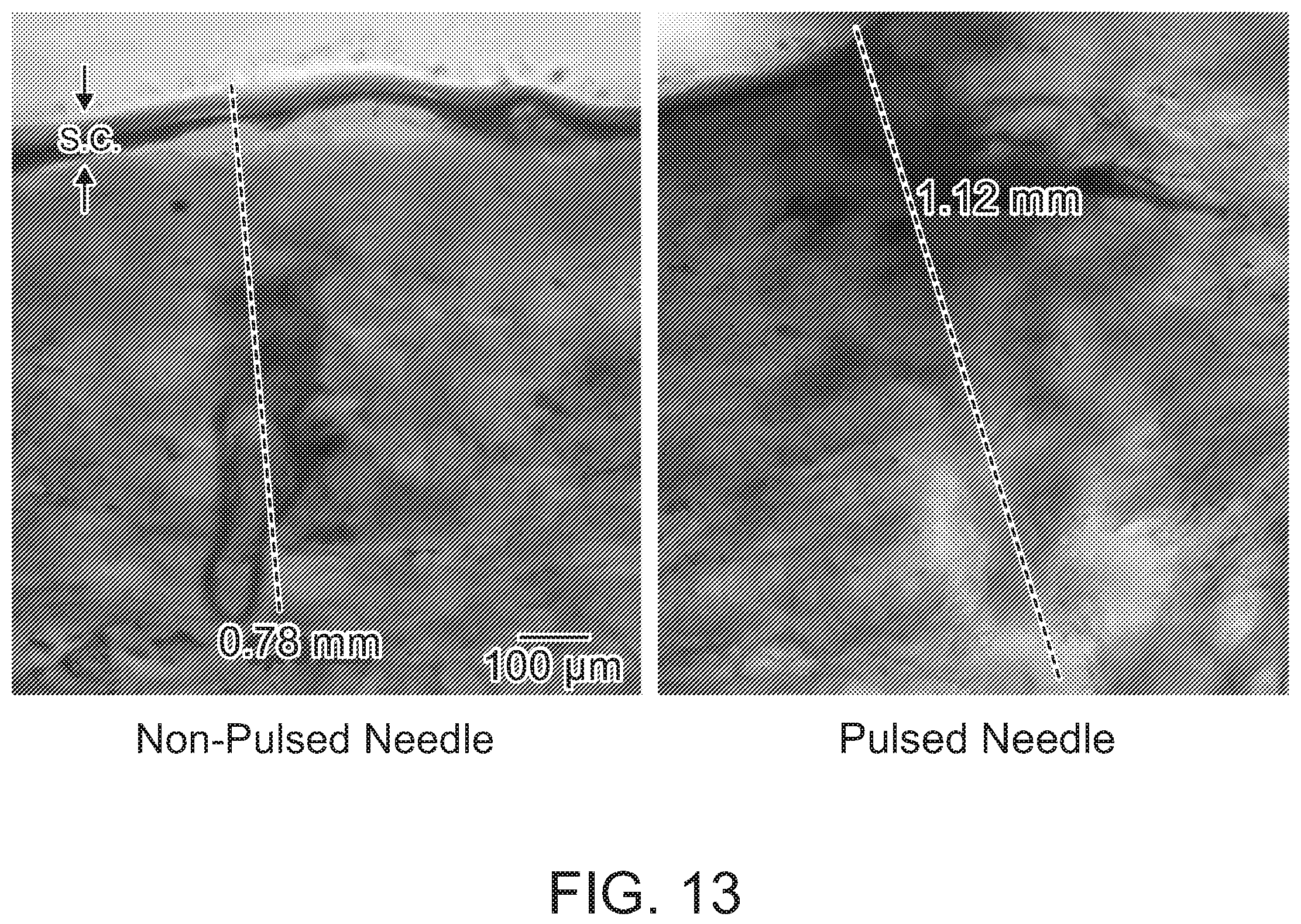 Patent US12508423 Figure 13 – Device for tissue electrotransfer using a microelectrode