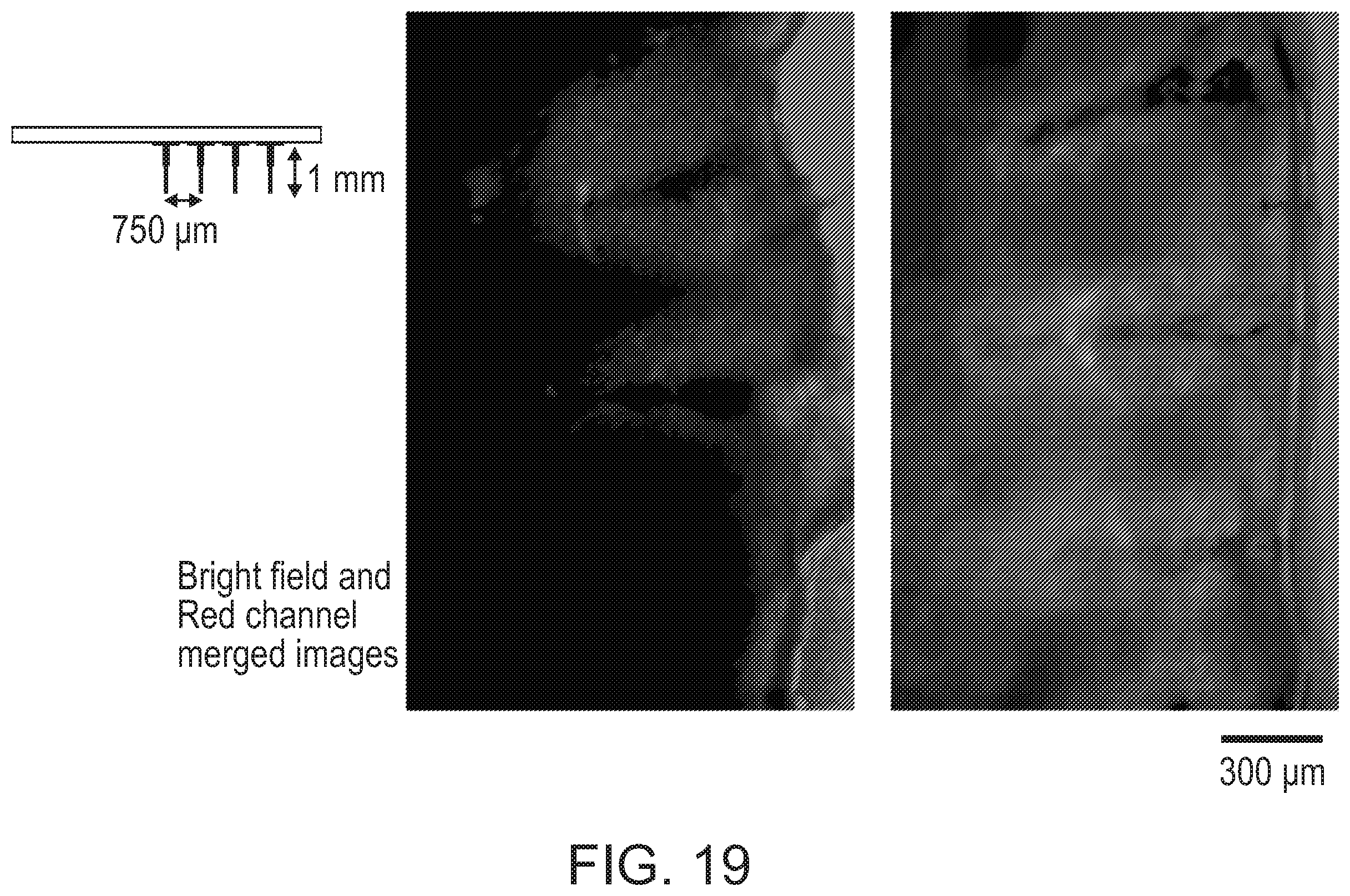 Patent US12508423 Figure 19 – Device for tissue electrotransfer using a microelectrode