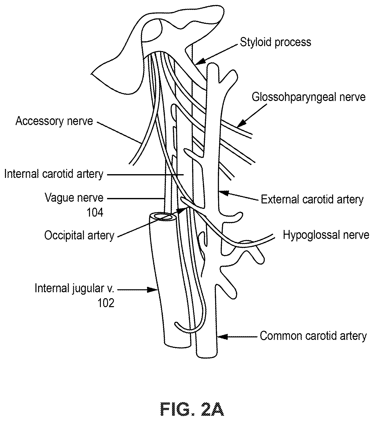 Patent US12508425 Figure 2 – Bilateral vagus nerve stimulation