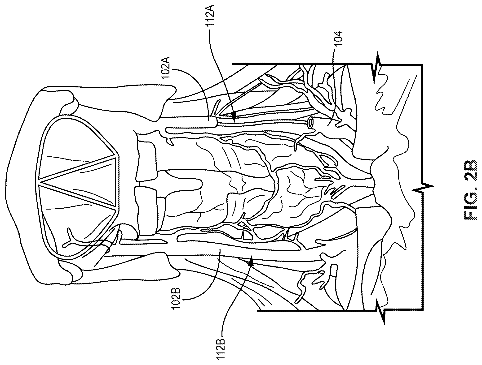 Patent US12508425 Figure 3 – Bilateral vagus nerve stimulation