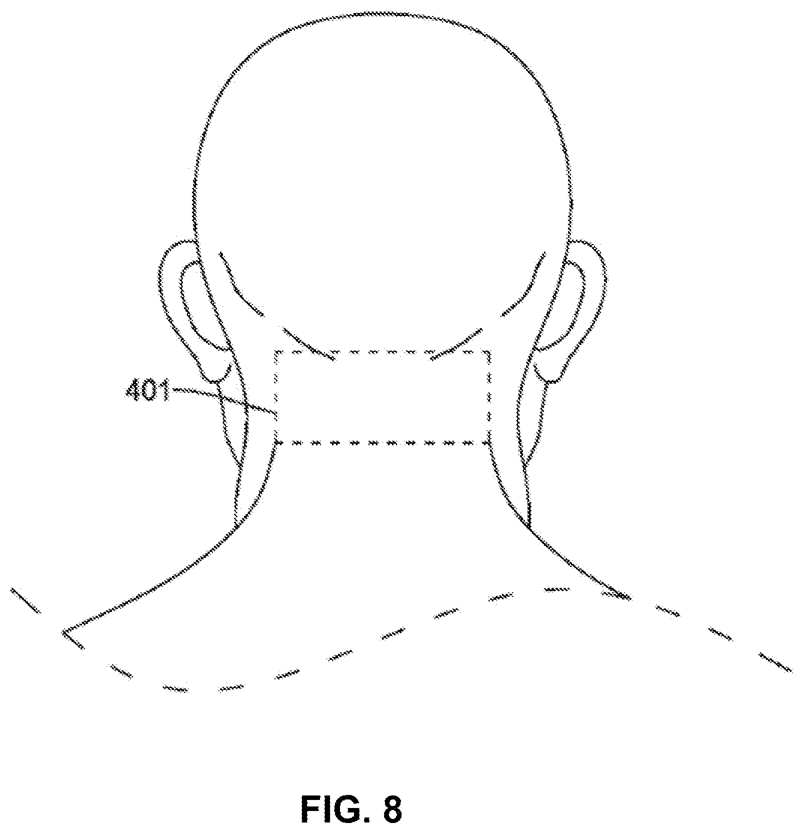 Patent US12508425 Figure 11 – Bilateral vagus nerve stimulation