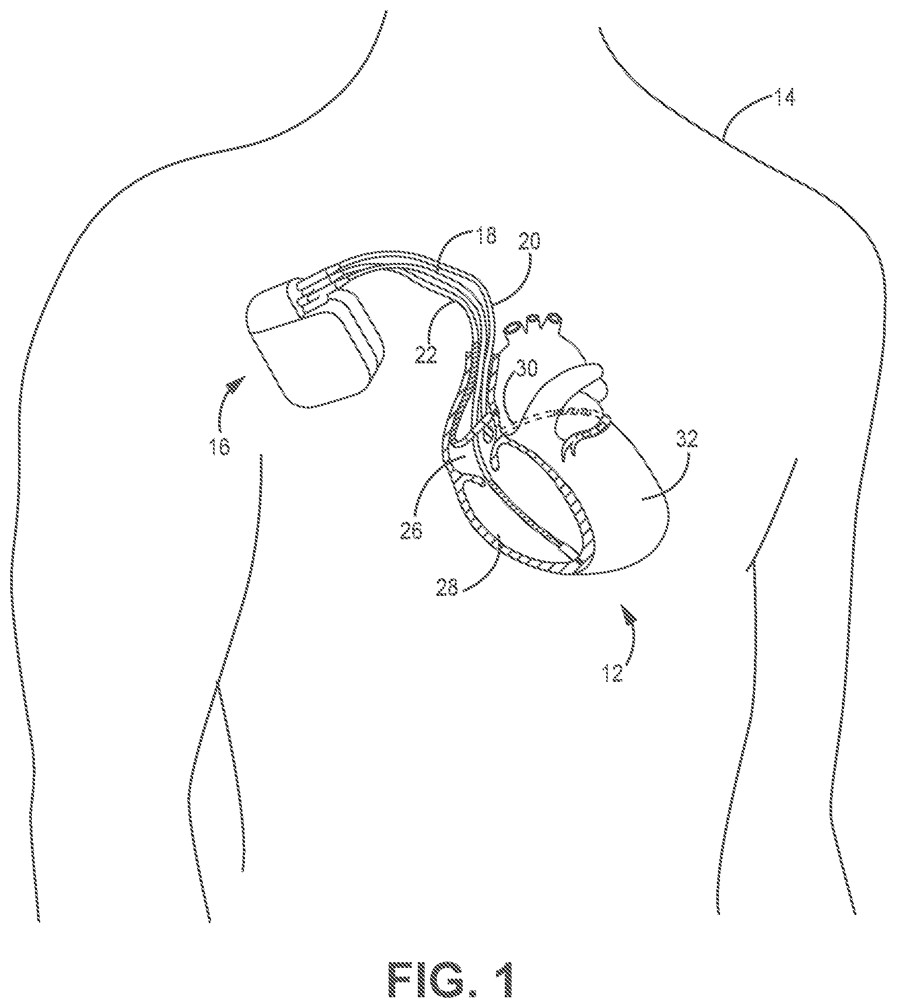 Patent US12508428 Figure 1 – Respiratory-based cardiac remodeling pacing therapy