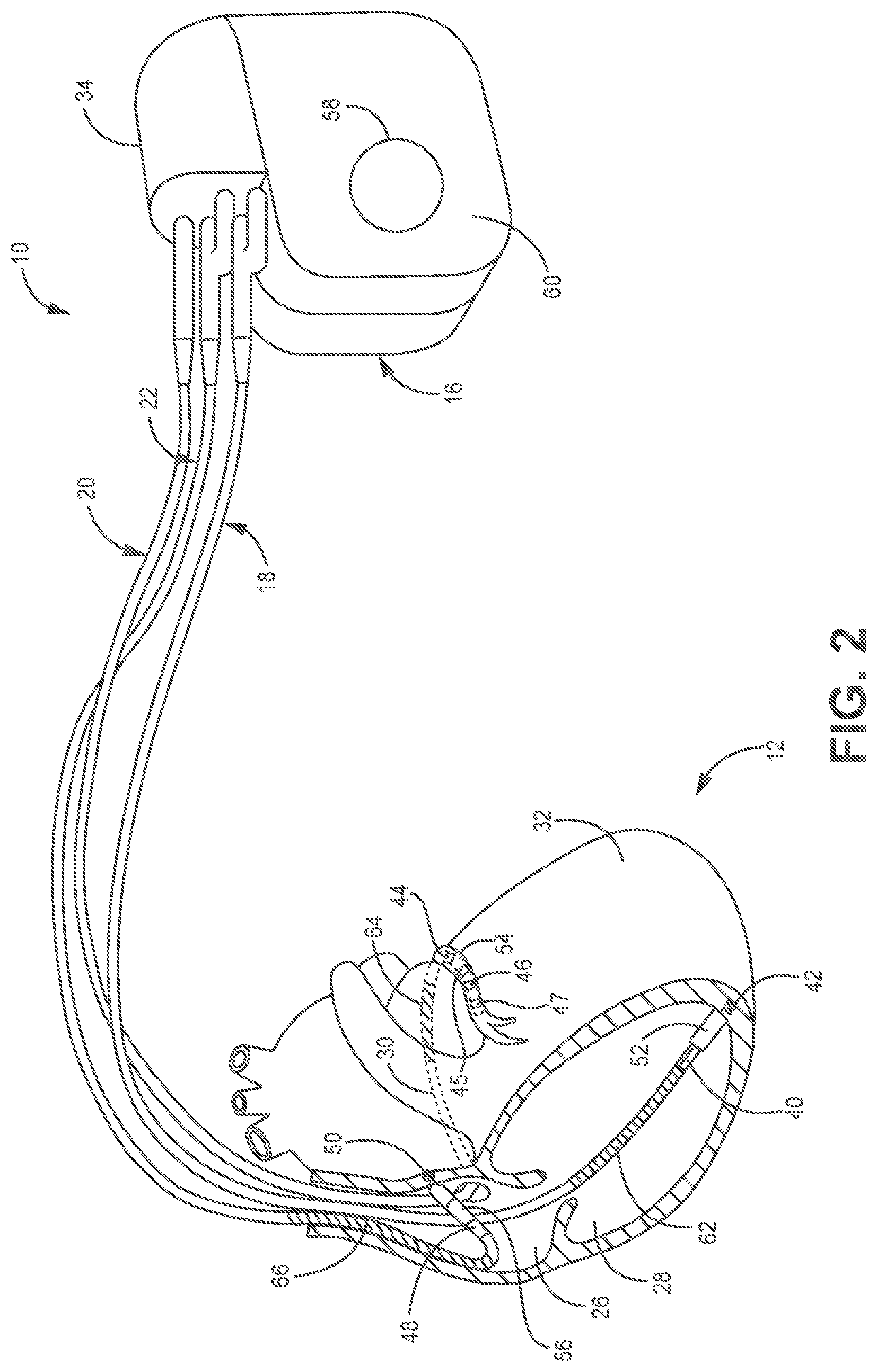 Patent US12508428 Figure 2 – Respiratory-based cardiac remodeling pacing therapy