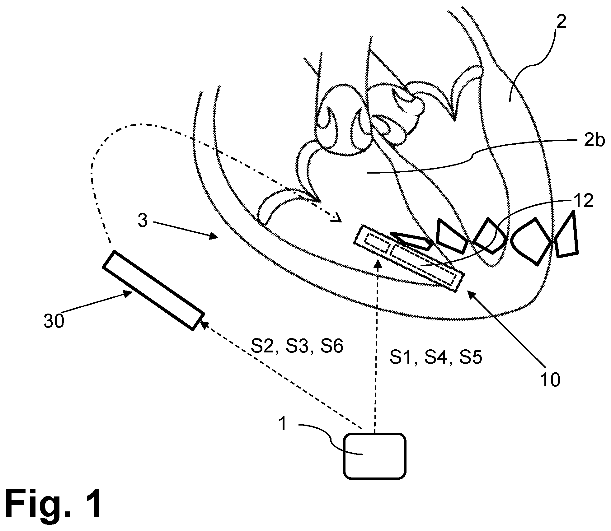 Patent US12508432 Figure 1 – Configurable replacement mechanism for leadless pacemaker system