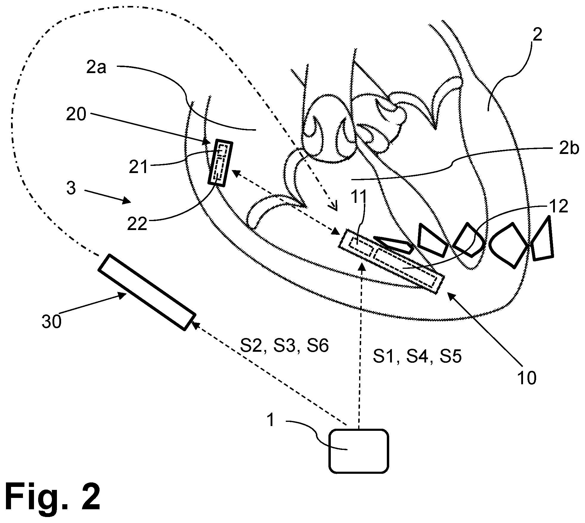 Patent US12508432 Figure 2 – Configurable replacement mechanism for leadless pacemaker system