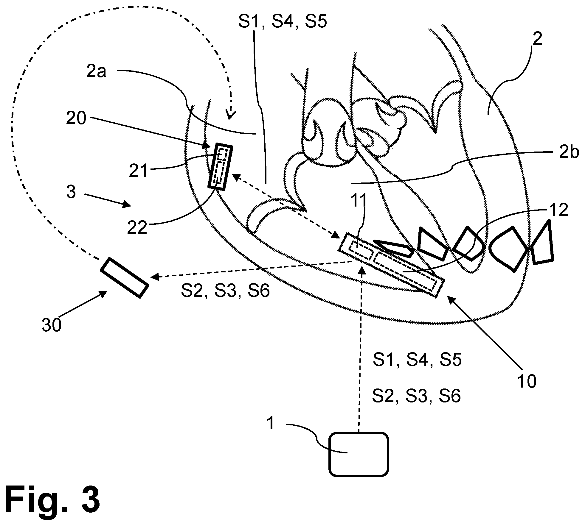 Patent US12508432 Figure 3 – Configurable replacement mechanism for leadless pacemaker system