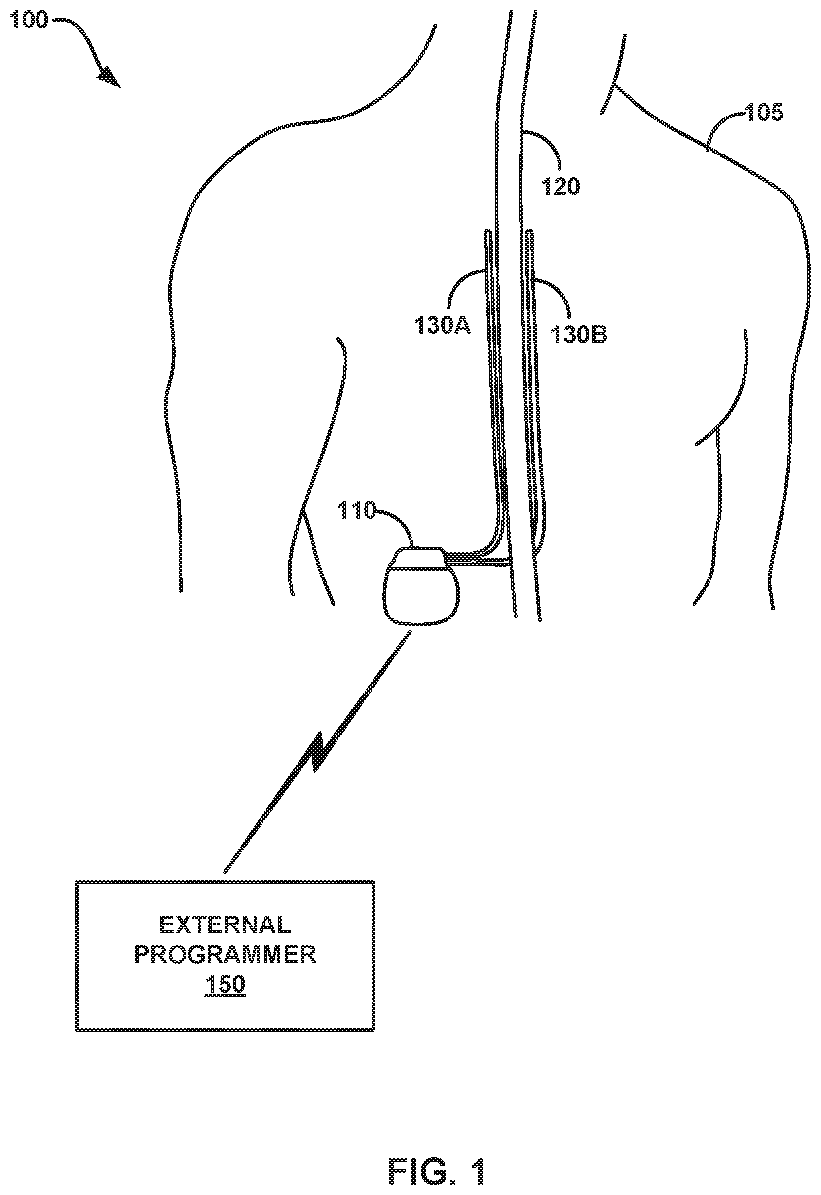 Patent US12508433 Figure 1 – Therapy programming based on evoked compound action potentials