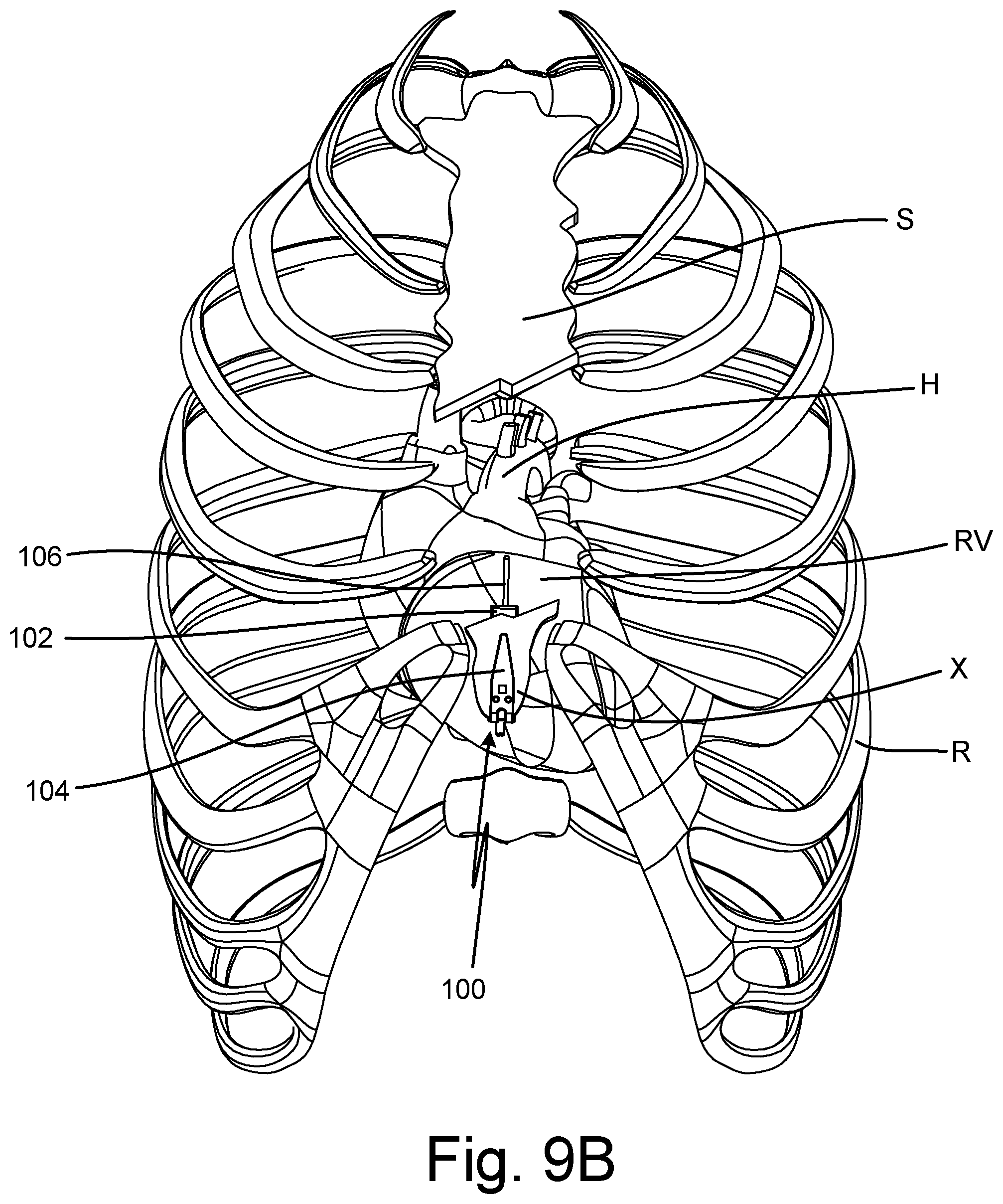 Patent US12508434 Figure 12 – Method of injecting subcutaneous device