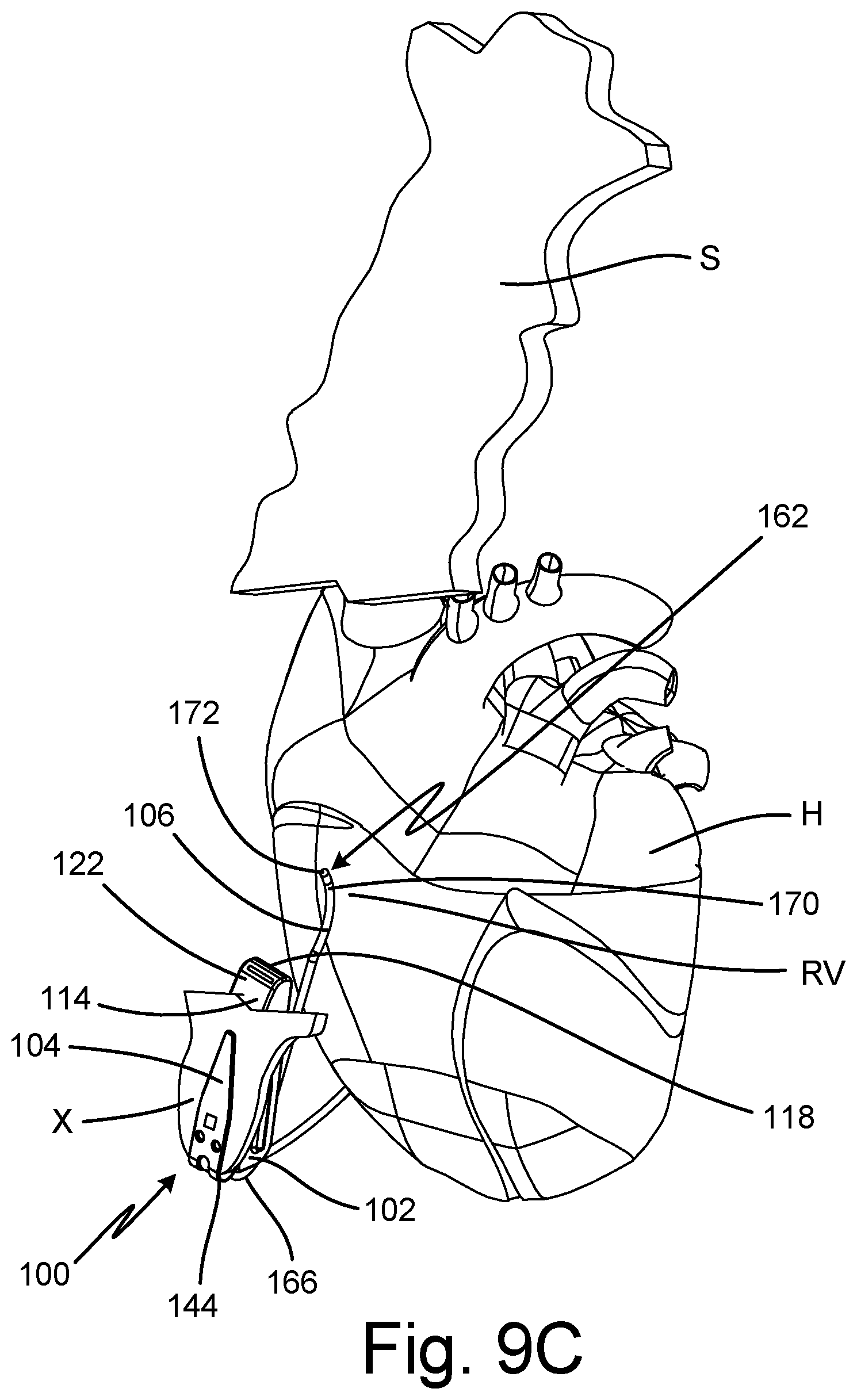 Patent US12508434 Figure 13 – Method of injecting subcutaneous device