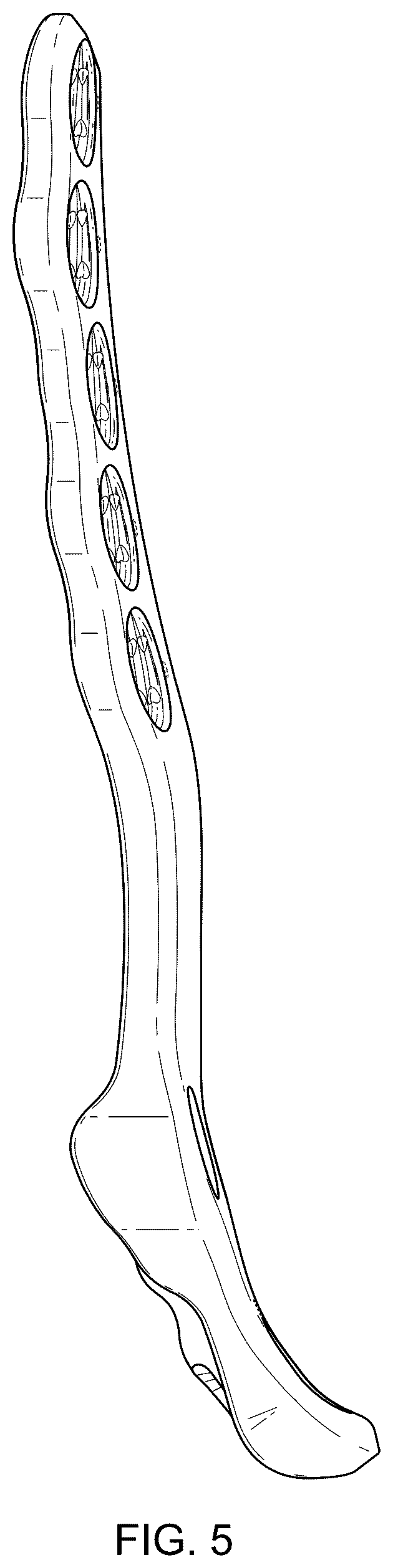 Patent USD1076090 Figure 5 – Straddle bone plate