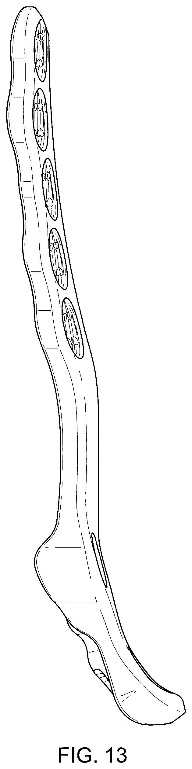 Patent USD1076090 Figure 12 – Straddle bone plate