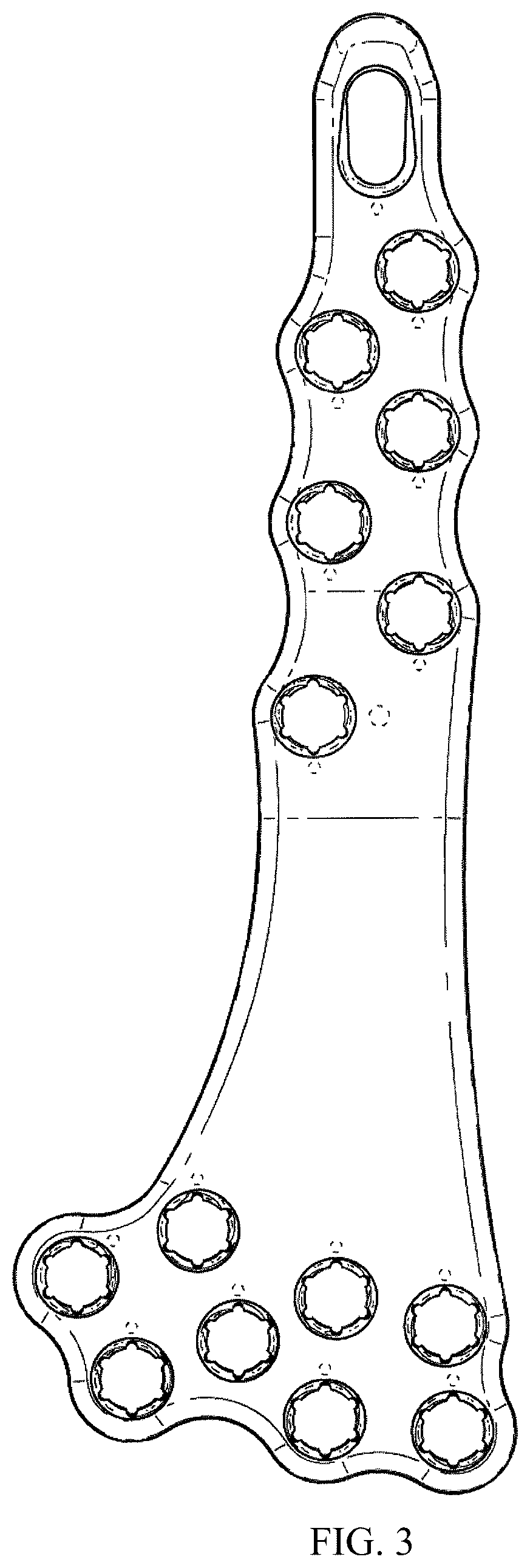 Patent USD1076091 Figure 3 – Straddle bone plate