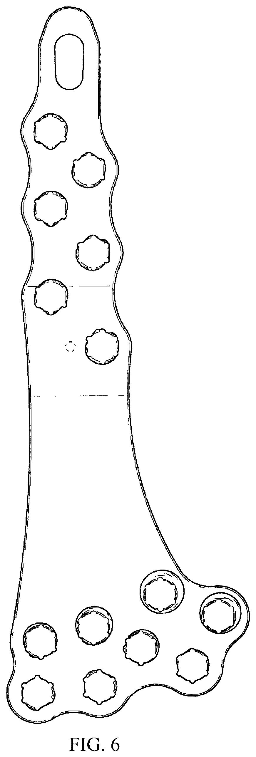 Patent USD1076091 Figure 5 – Straddle bone plate