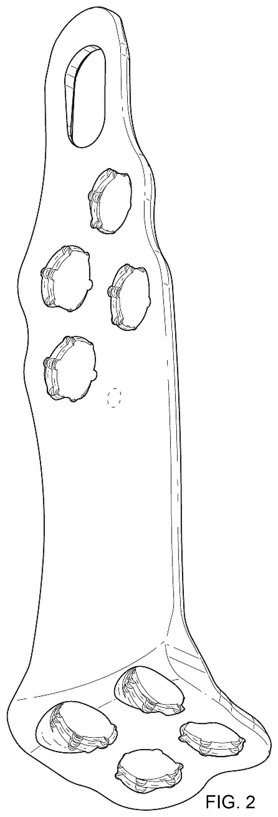 Patent USD1076092 Figure 2 – Span bone plate