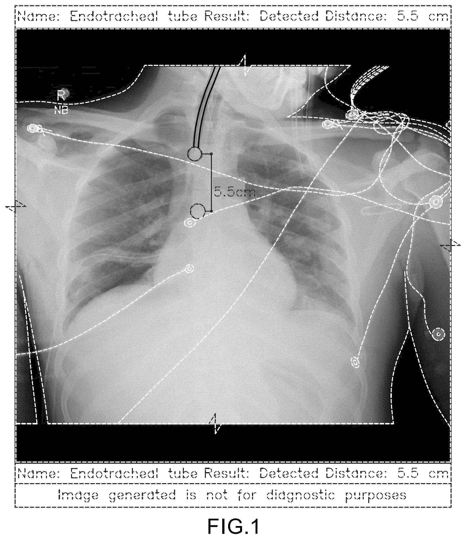 Patent USD1077854 Figure 1 – Display screen or portion thereof with a computer generated graphical user interface for placement of a medical tube or line