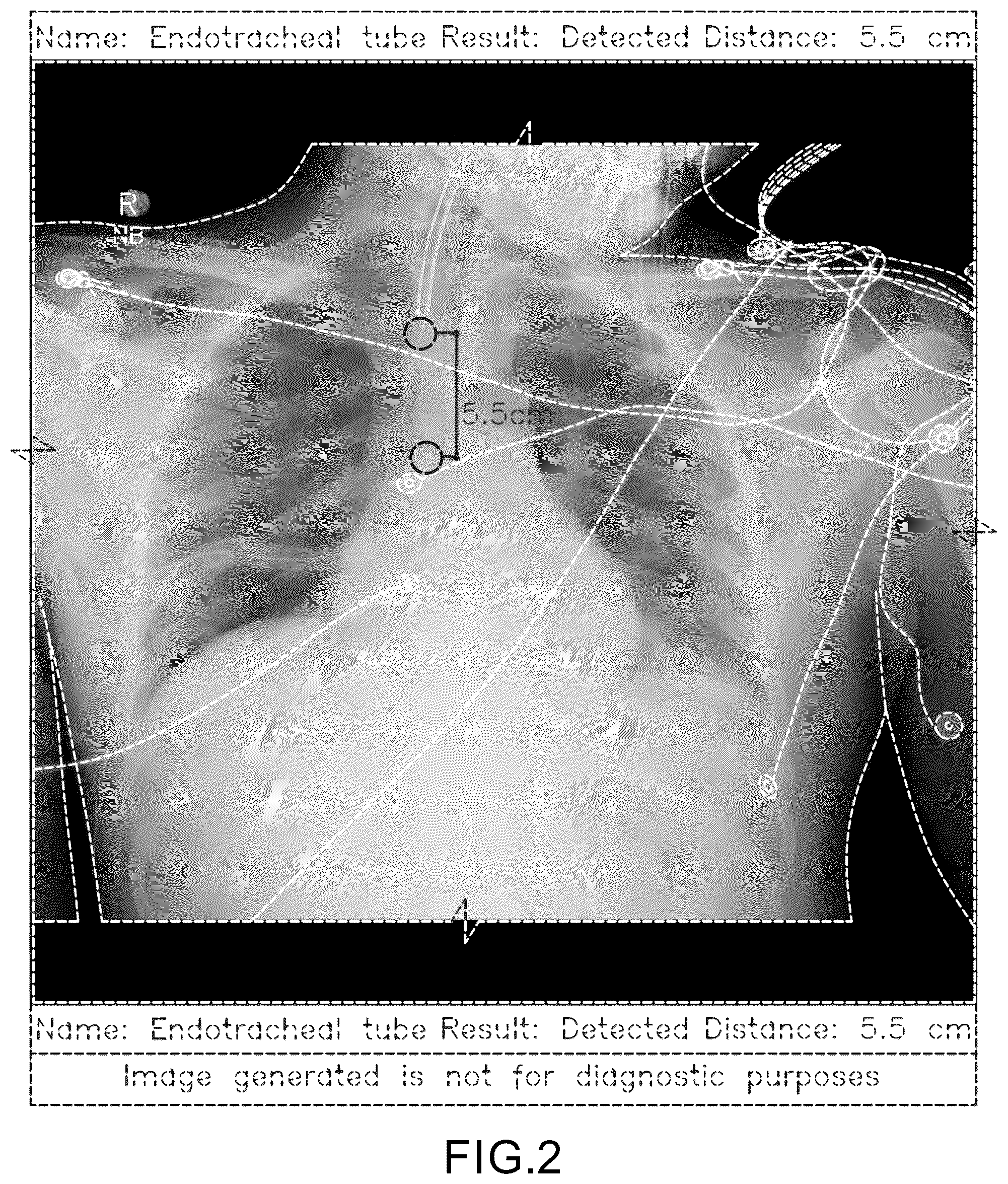 Patent USD1077854 Figure 2 – Display screen or portion thereof with a computer generated graphical user interface for placement of a medical tube or line