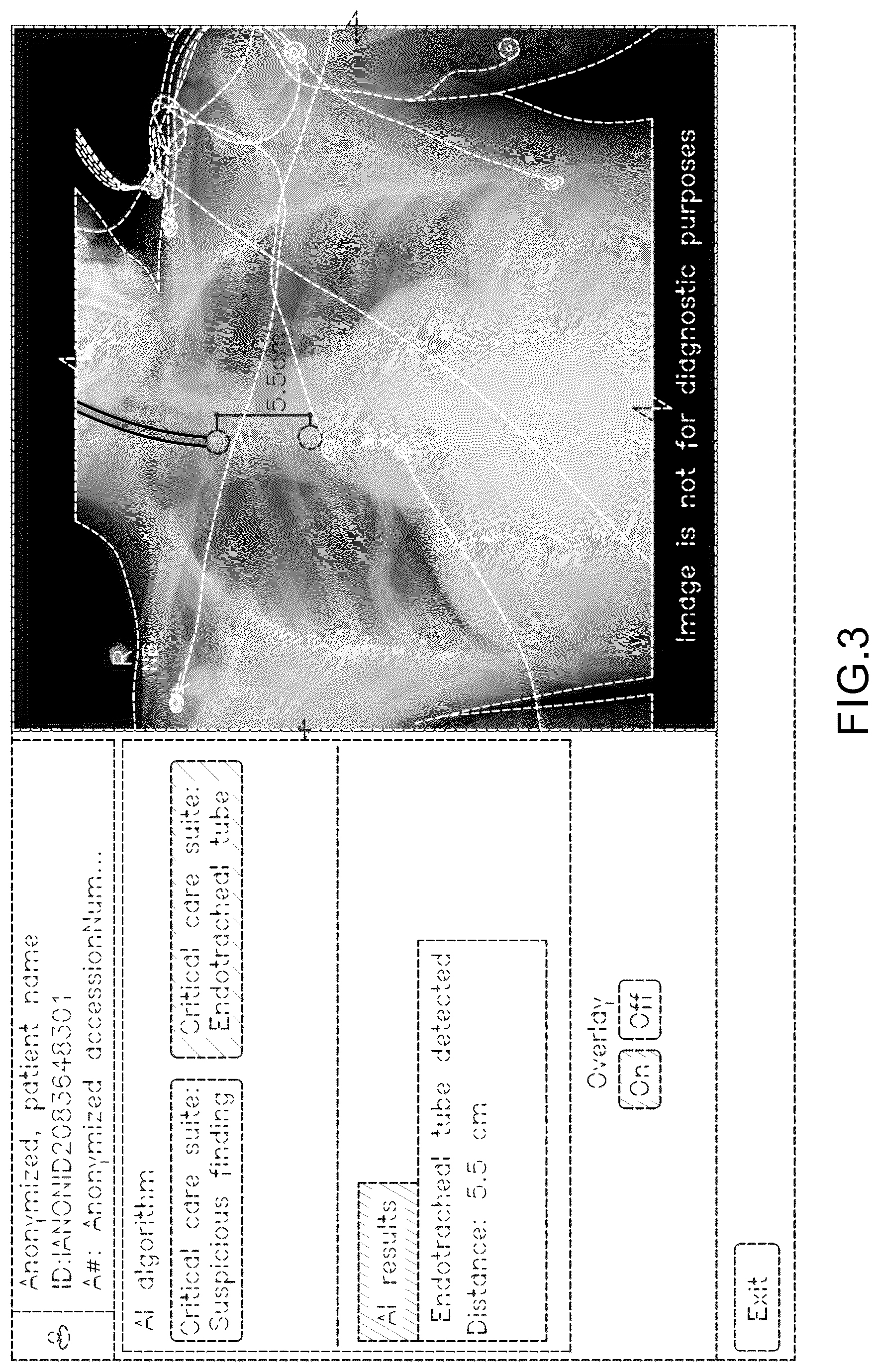 Patent USD1077854 Figure 3 – Display screen or portion thereof with a computer generated graphical user interface for placement of a medical tube or line
